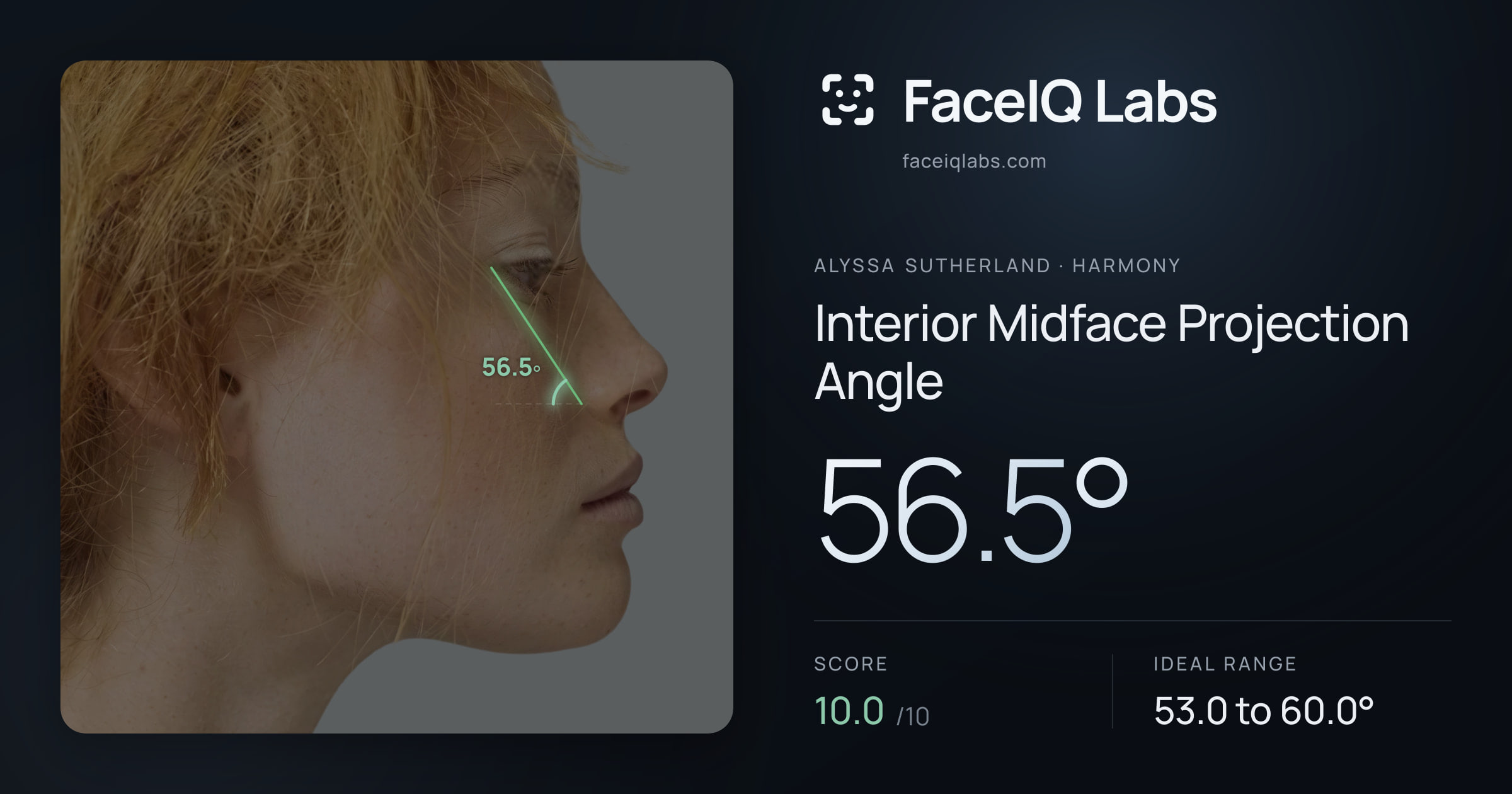 Alyssa Sutherland Interior Midface Projection Angle: 56.5°, drawn on the photo