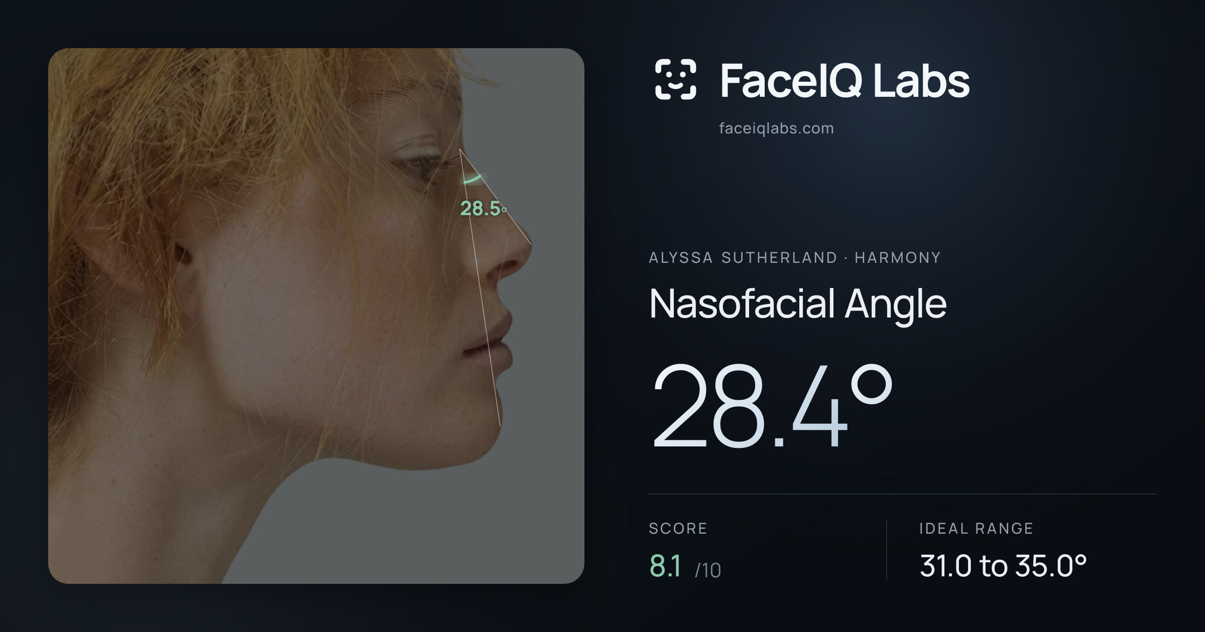 Alyssa Sutherland Nasofacial Angle: 28.4°, drawn on the photo
