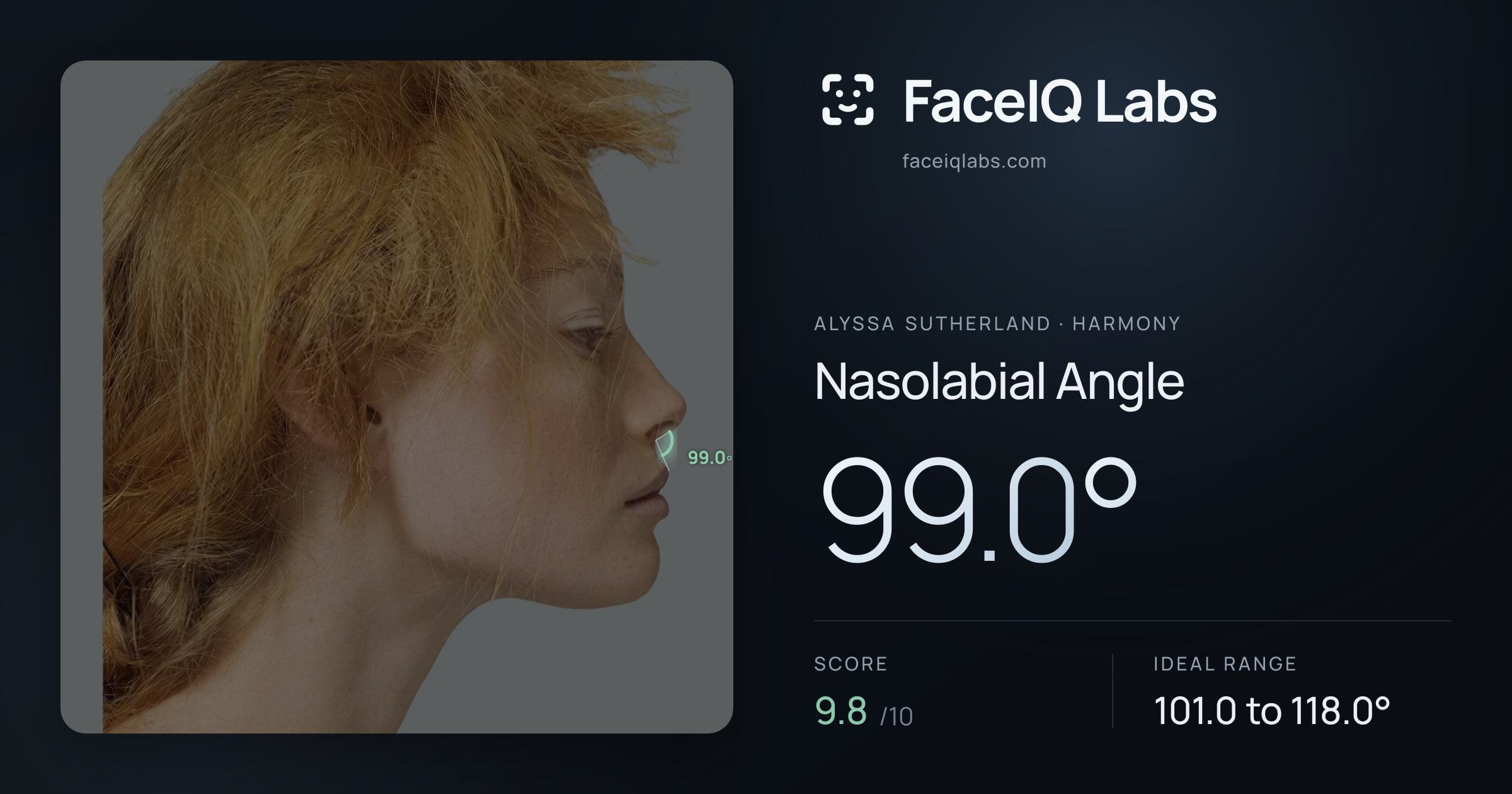 Alyssa Sutherland Nasolabial Angle: 99.0°, drawn on the photo