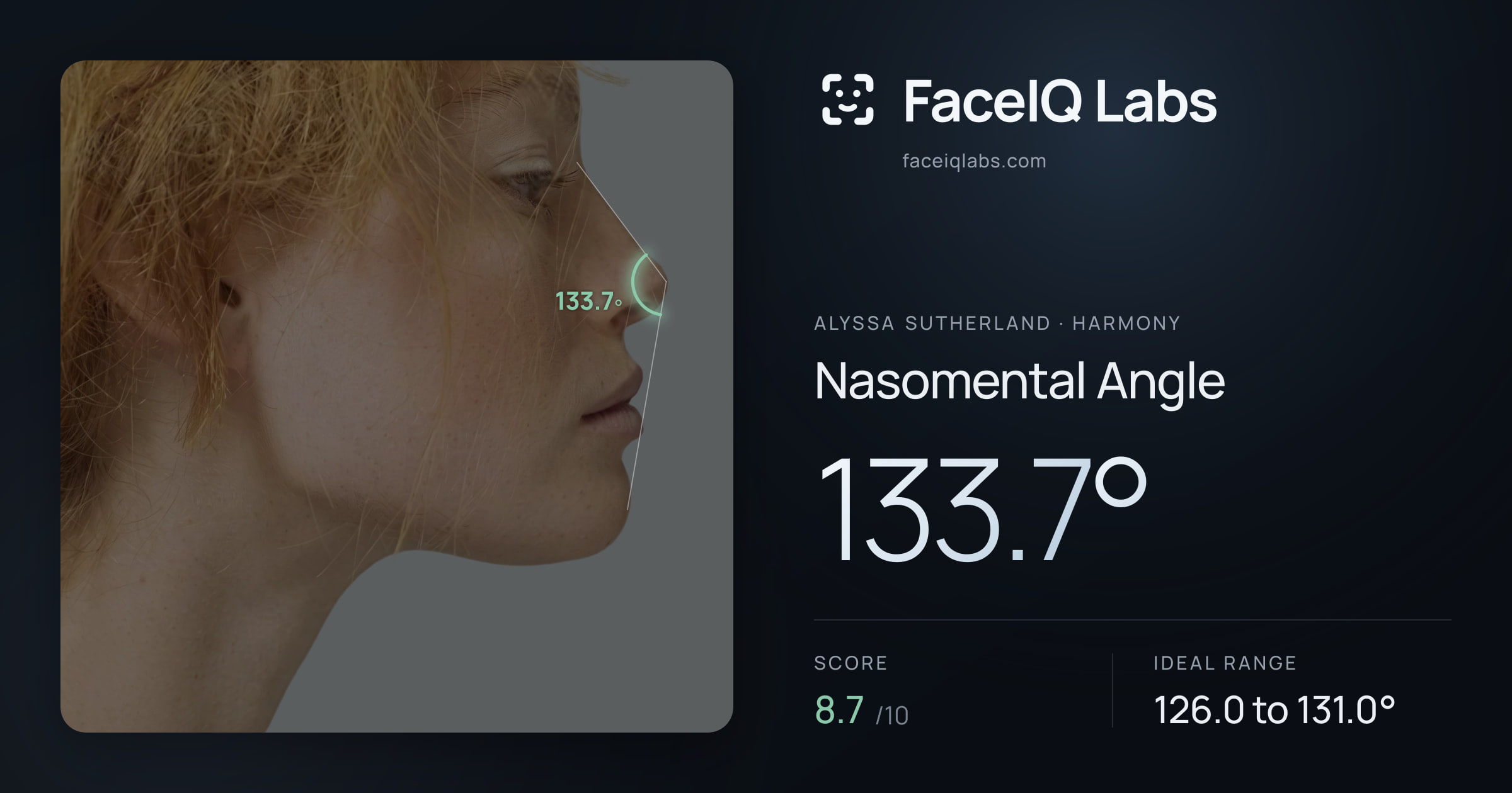 Alyssa Sutherland Nasomental Angle: 133.7°, drawn on the photo