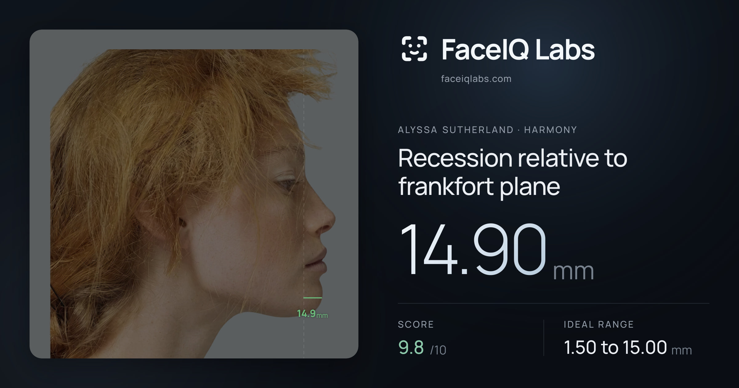 Alyssa Sutherland Recession relative to frankfort plane: 14.90mm, drawn on the photo