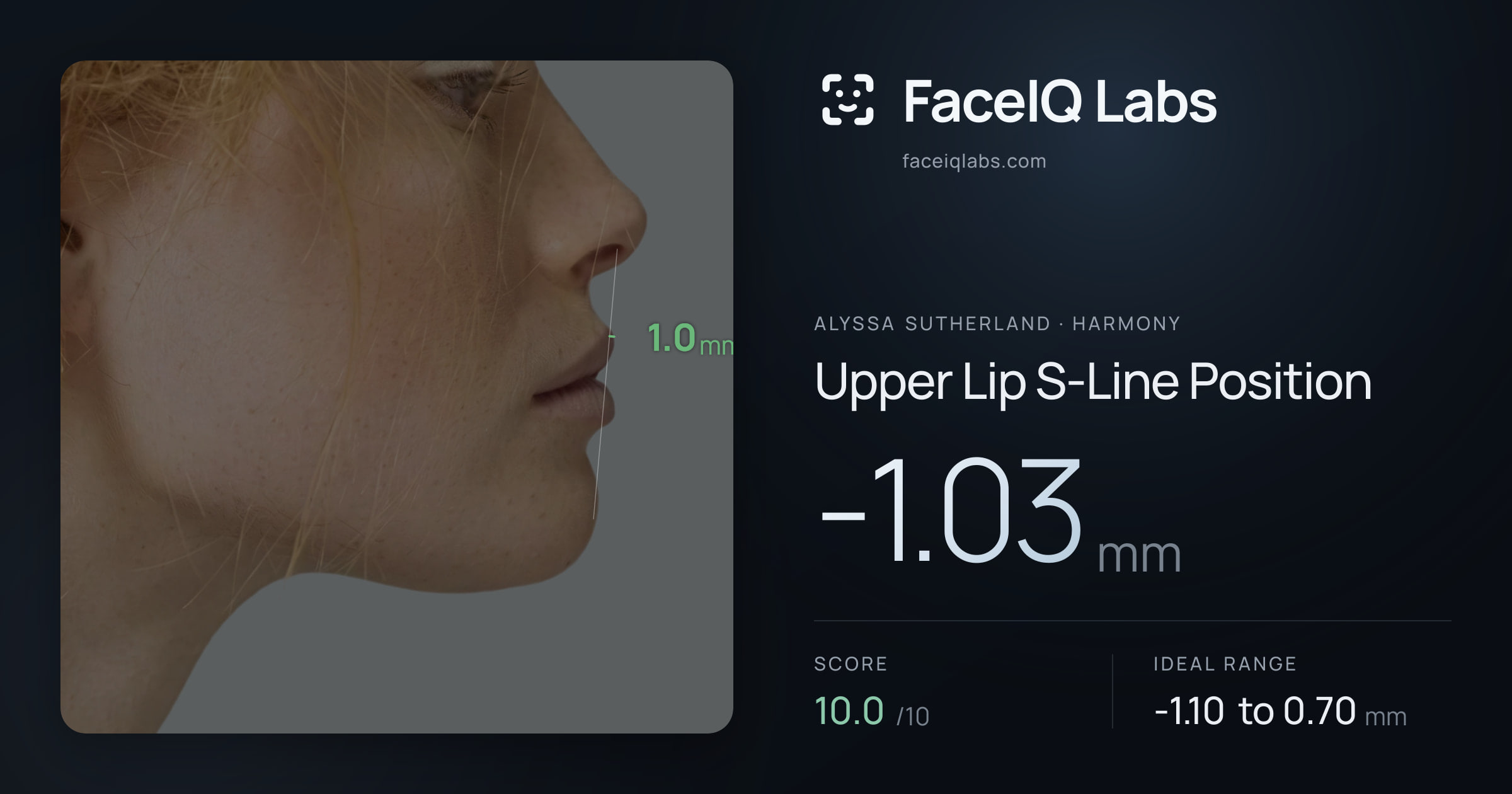 Alyssa Sutherland Upper Lip S-Line Position: -1.03mm, drawn on the photo