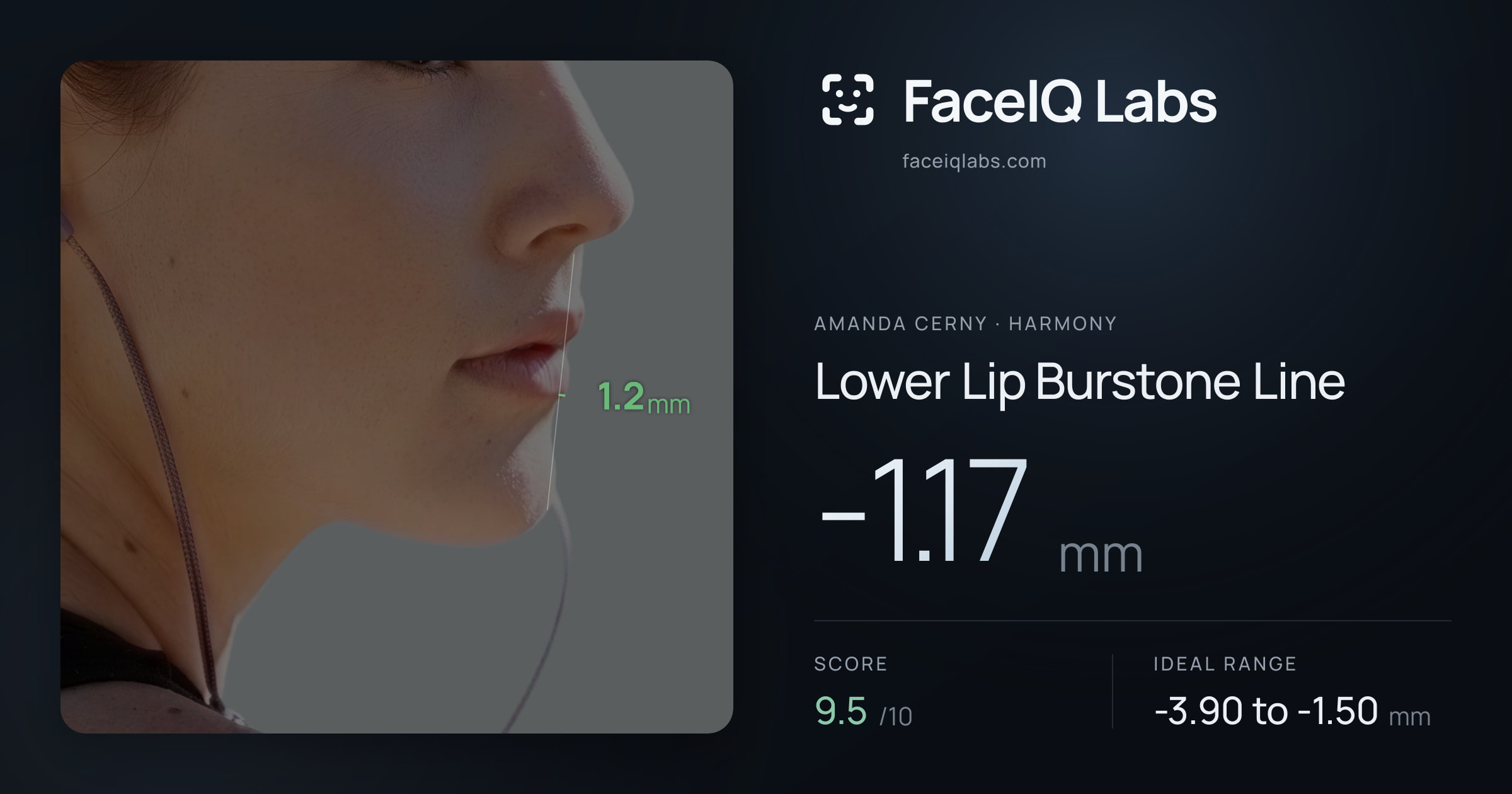 Amanda Cerny Lower Lip Burstone Line: -1.17mm, drawn on the photo