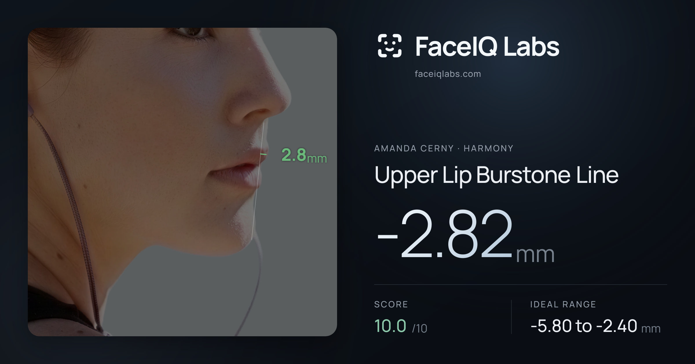 Amanda Cerny Upper Lip Burstone Line: -2.82mm, drawn on the photo