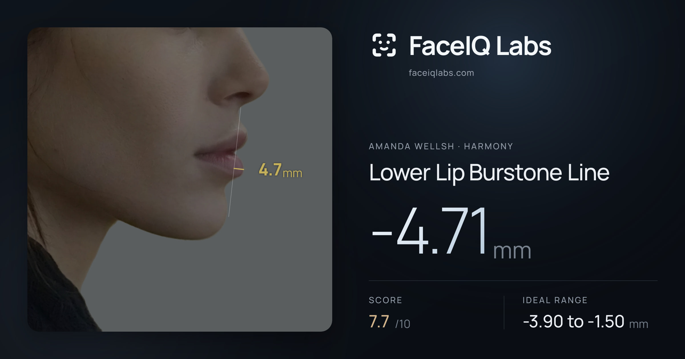 Amanda Wellsh Lower Lip Burstone Line: -4.71mm, drawn on the photo