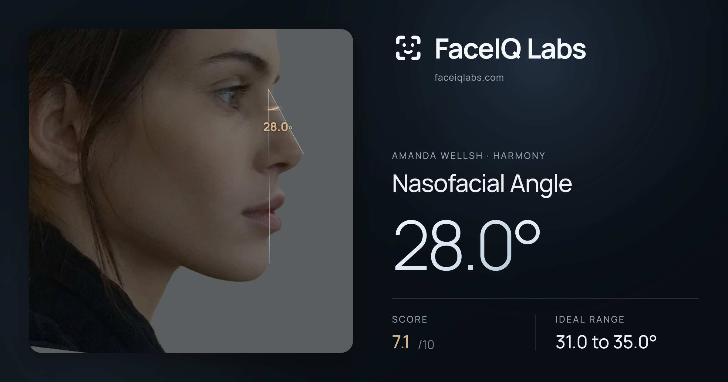 Amanda Wellsh Nasofacial Angle: 28.0°, drawn on the photo