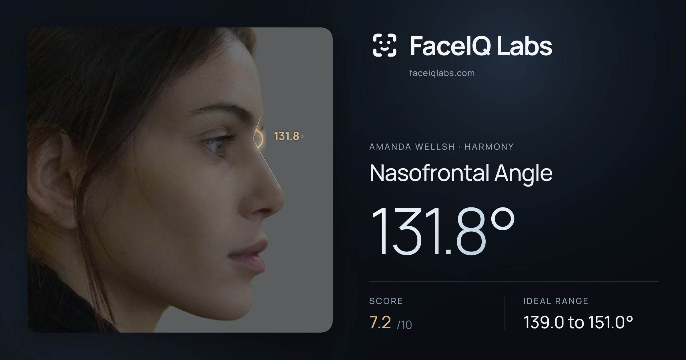 Amanda Wellsh Nasofrontal Angle: 131.8°, drawn on the photo