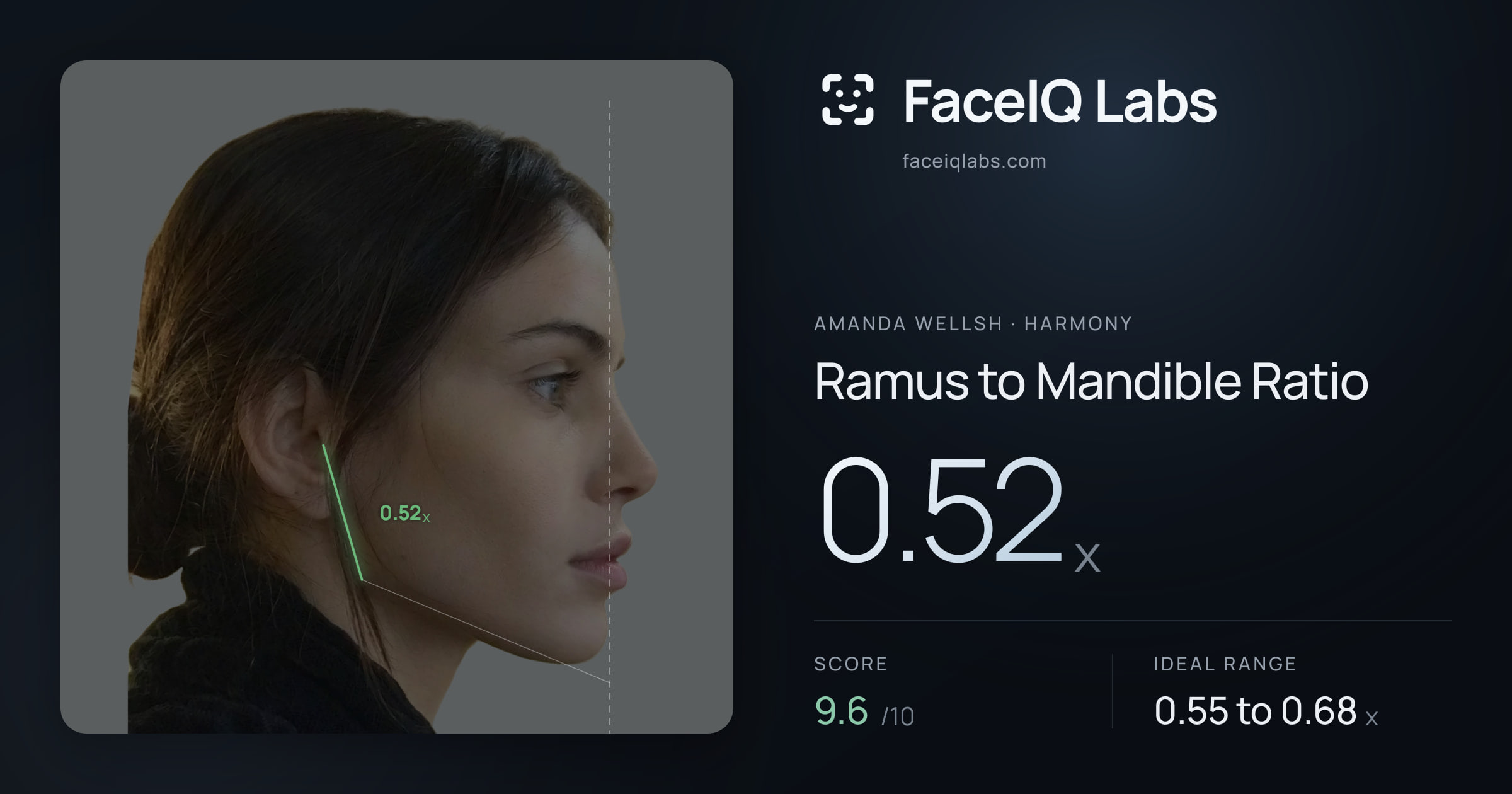 Amanda Wellsh Ramus to Mandible Ratio: 0.52x, drawn on the photo