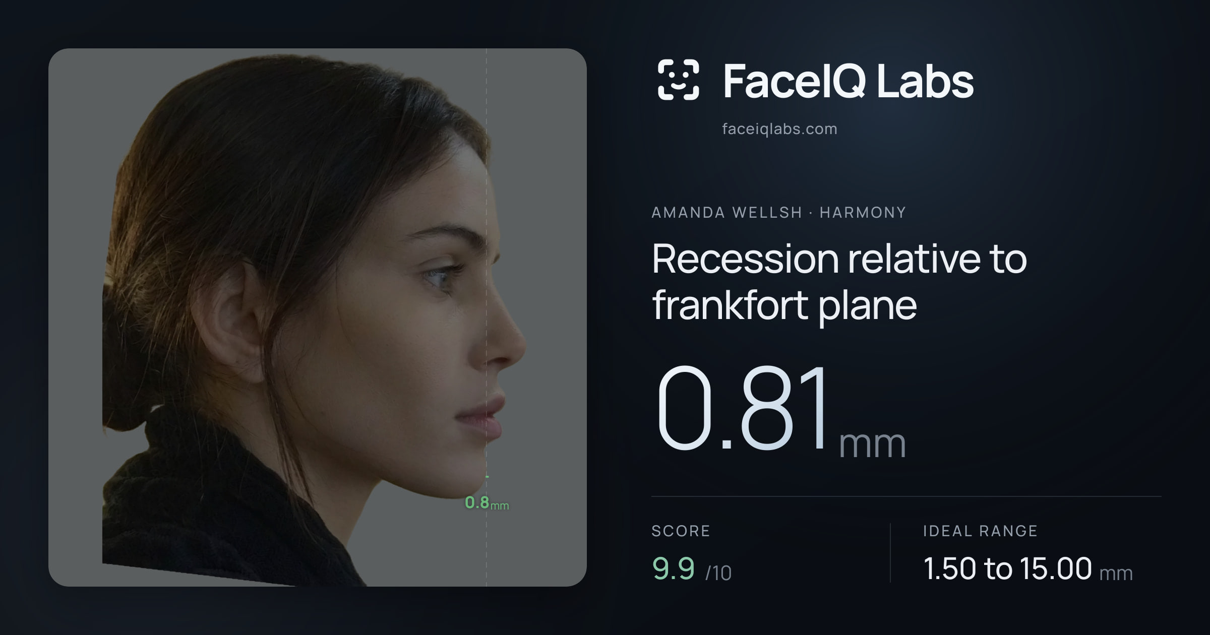 Amanda Wellsh Recession relative to frankfort plane: 0.81mm, drawn on the photo