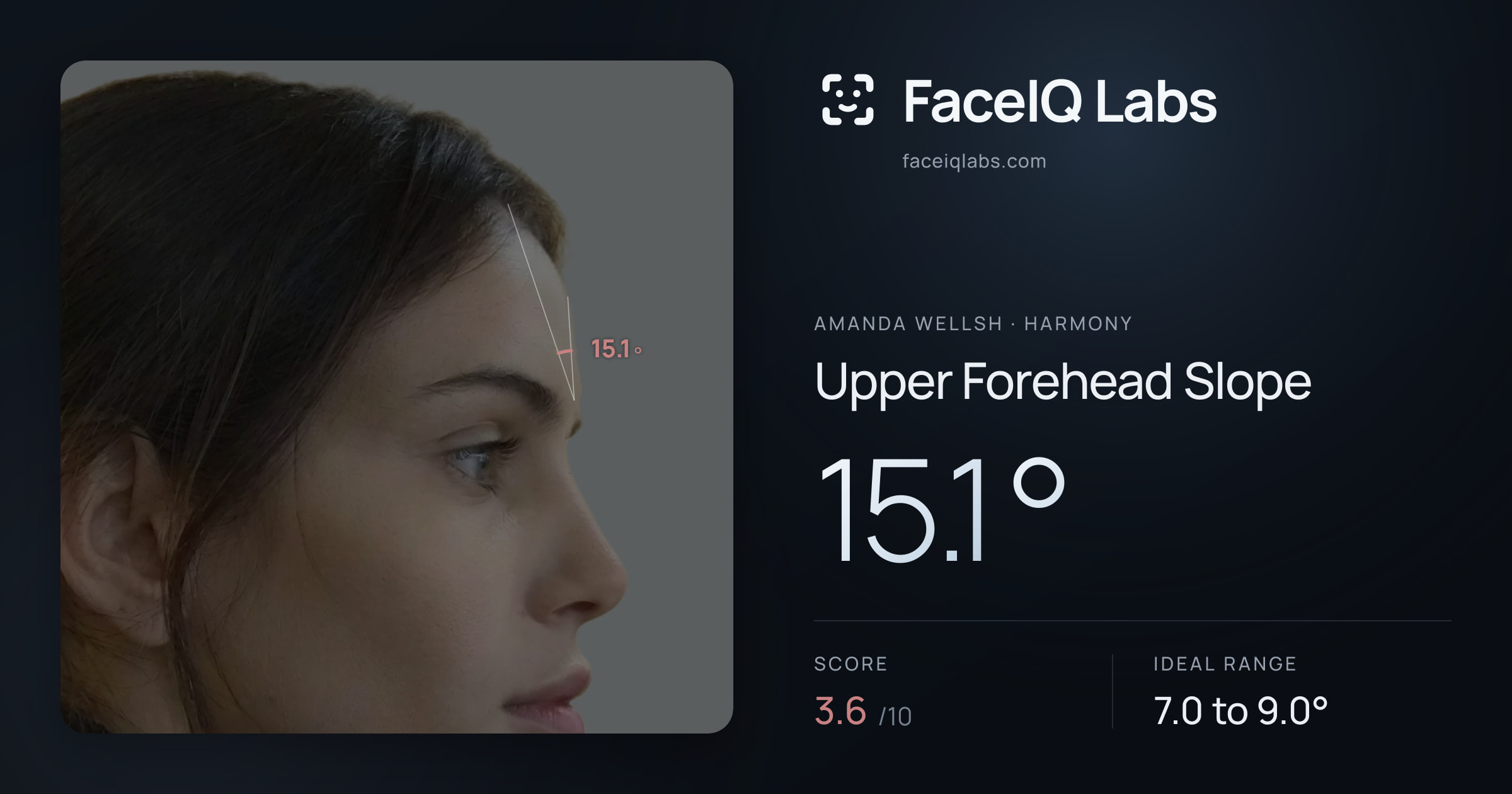 Amanda Wellsh Upper Forehead Slope: 15.1°, drawn on the photo