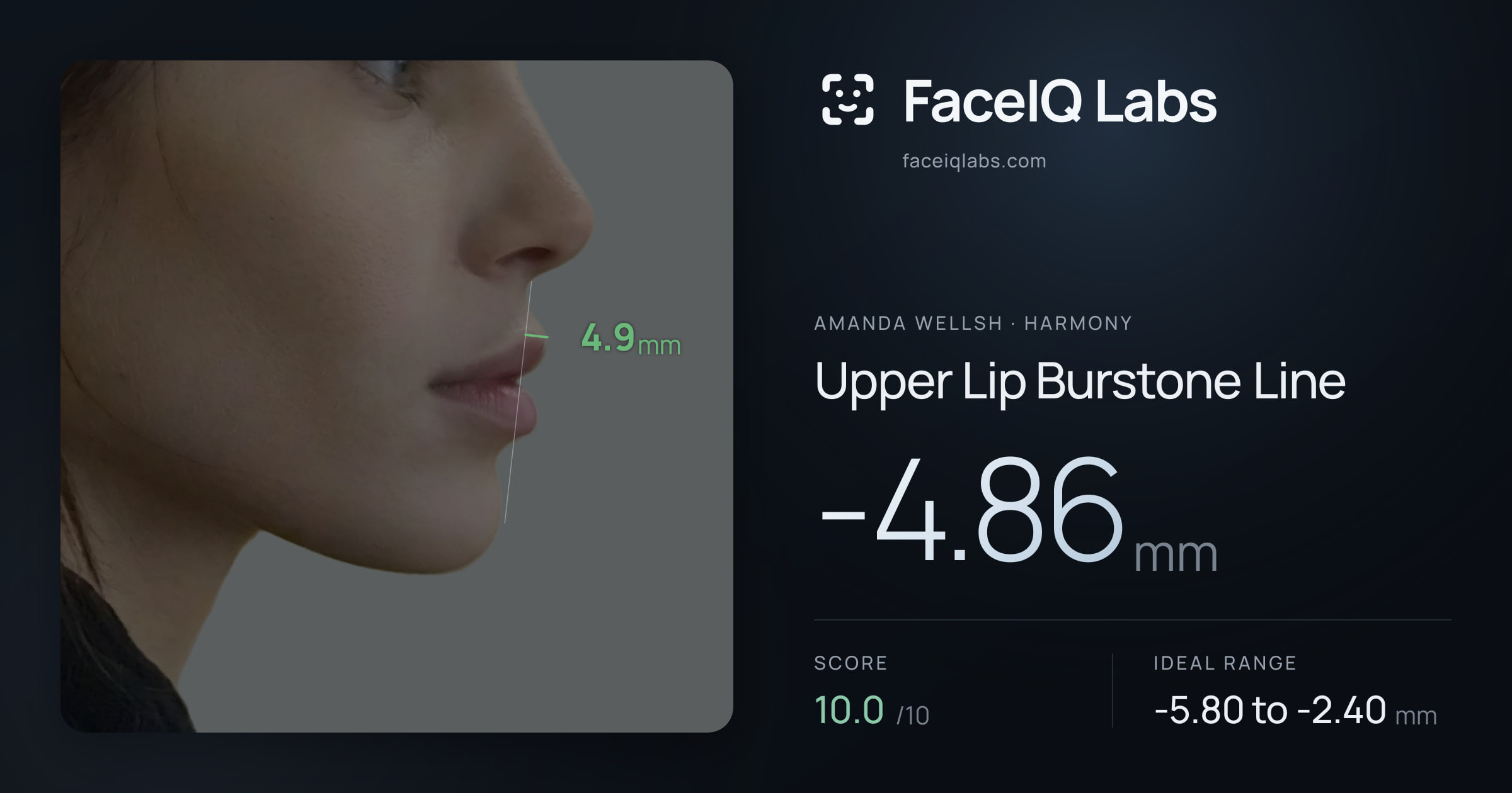Amanda Wellsh Upper Lip Burstone Line: -4.86mm, drawn on the photo