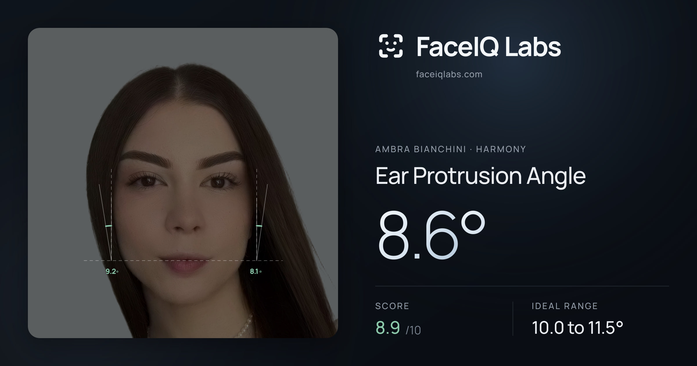 Ambra Bianchini Ear Protrusion Angle: 8.6°, drawn on the photo