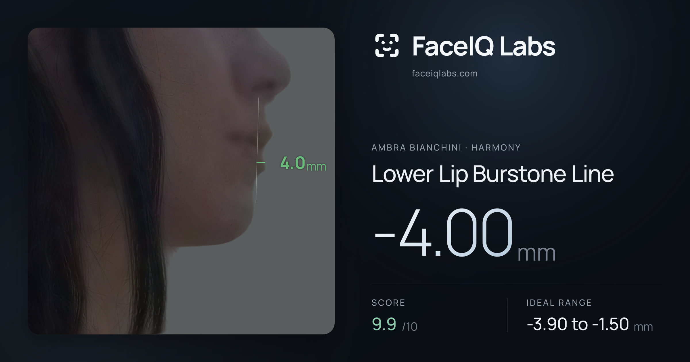 Ambra Bianchini Lower Lip Burstone Line: -4.00mm, drawn on the photo