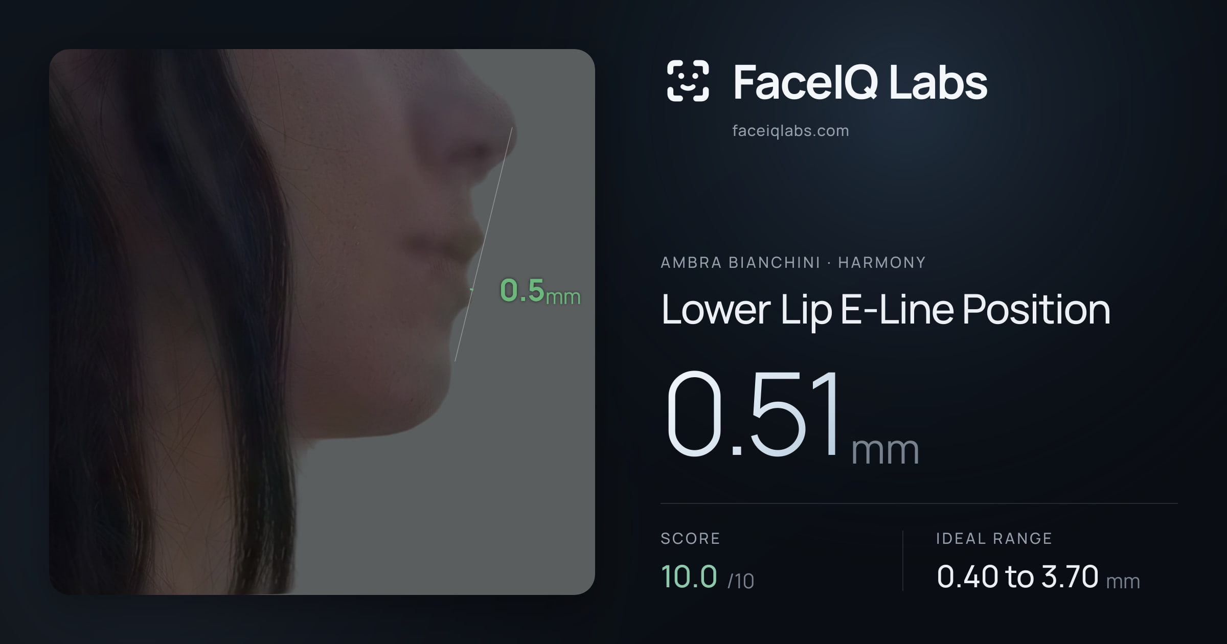 Ambra Bianchini Lower Lip E-Line Position: 0.51mm, drawn on the photo