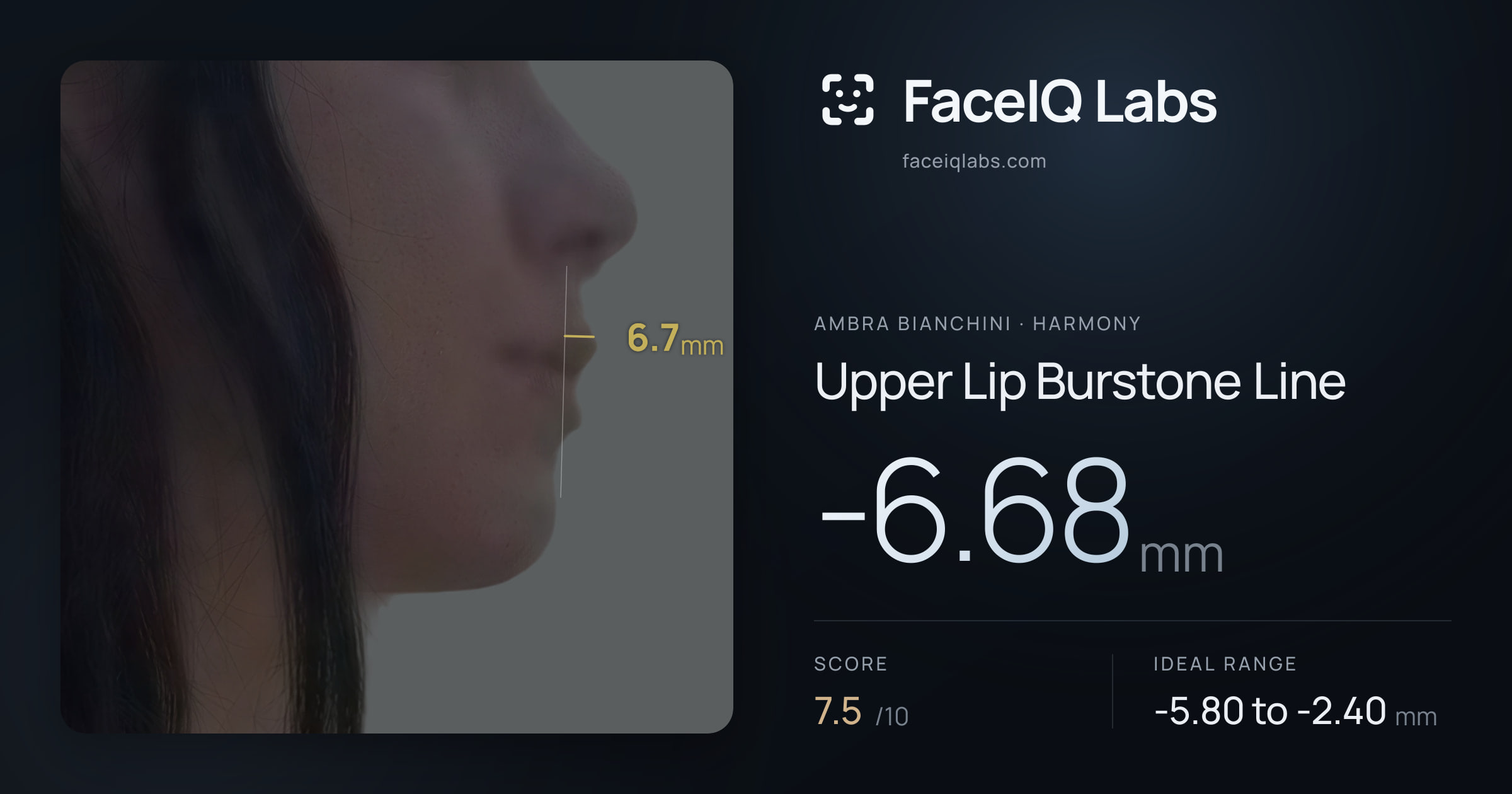 Ambra Bianchini Upper Lip Burstone Line: -6.68mm, drawn on the photo