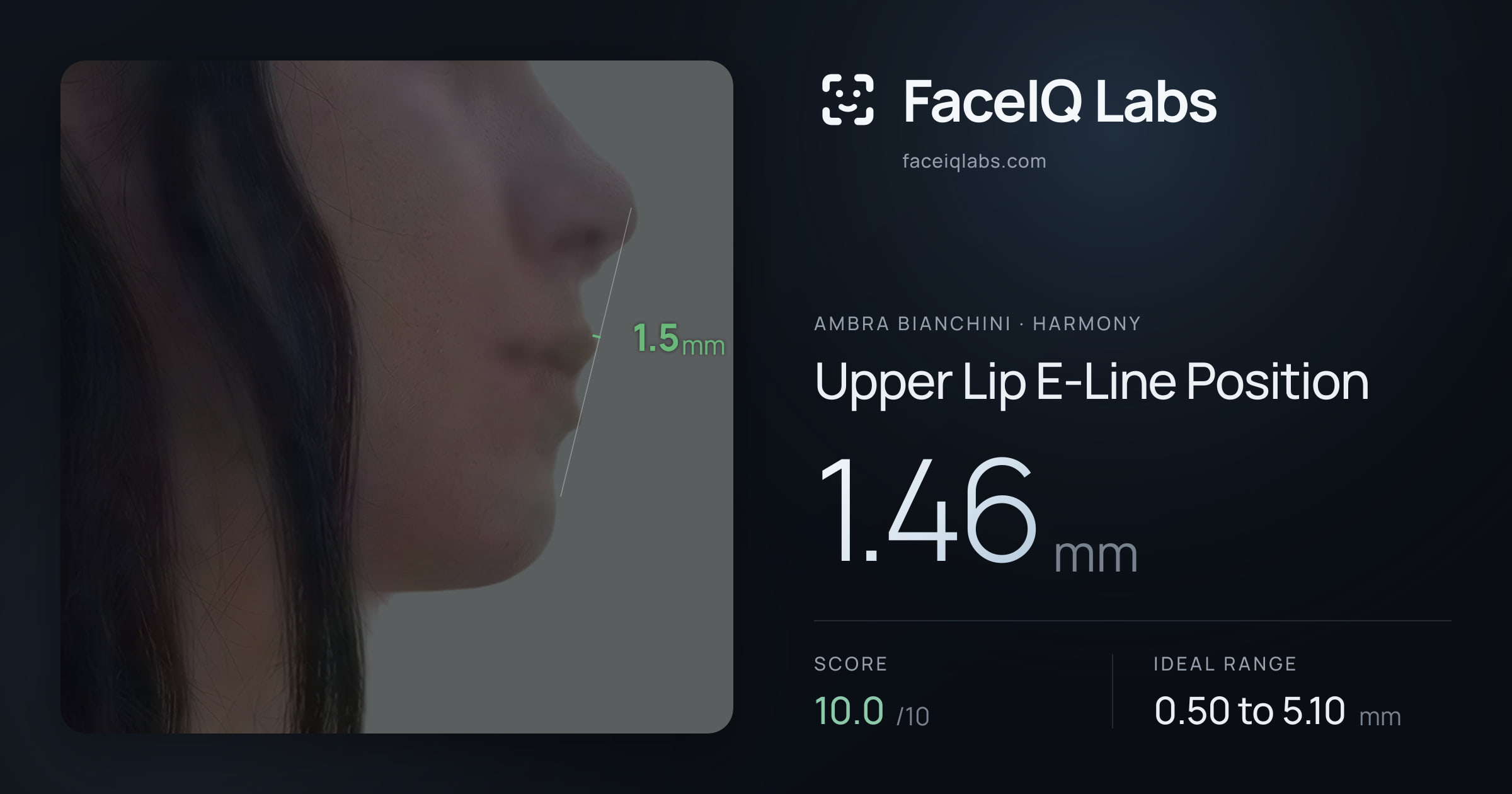 Ambra Bianchini Upper Lip E-Line Position: 1.46mm, drawn on the photo
