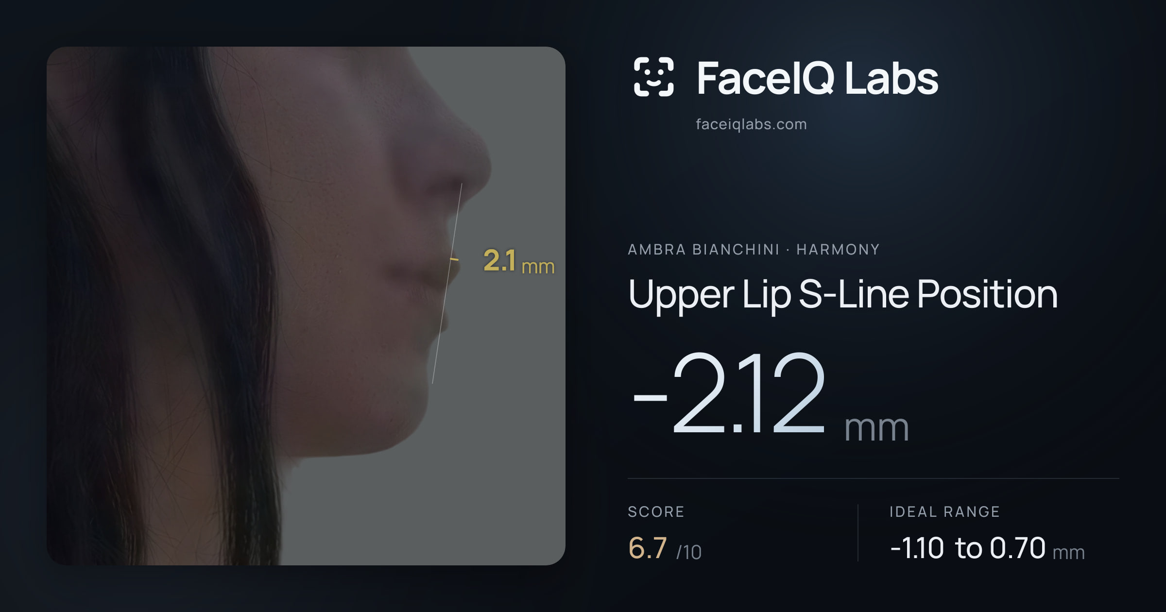 Ambra Bianchini Upper Lip S-Line Position: -2.12mm, drawn on the photo