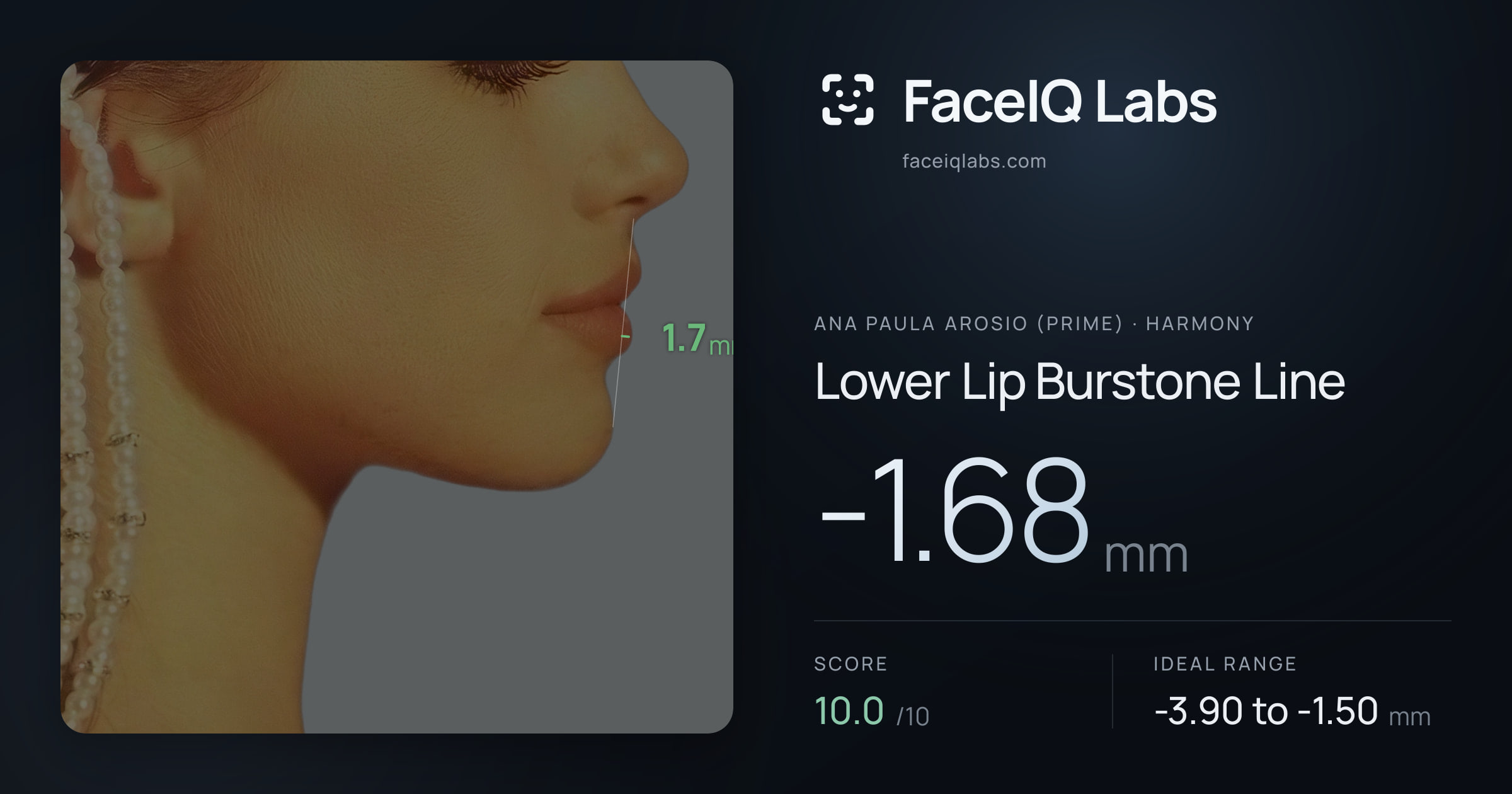 Ana paula arosio (prime) Lower Lip Burstone Line: -1.68mm, drawn on the photo