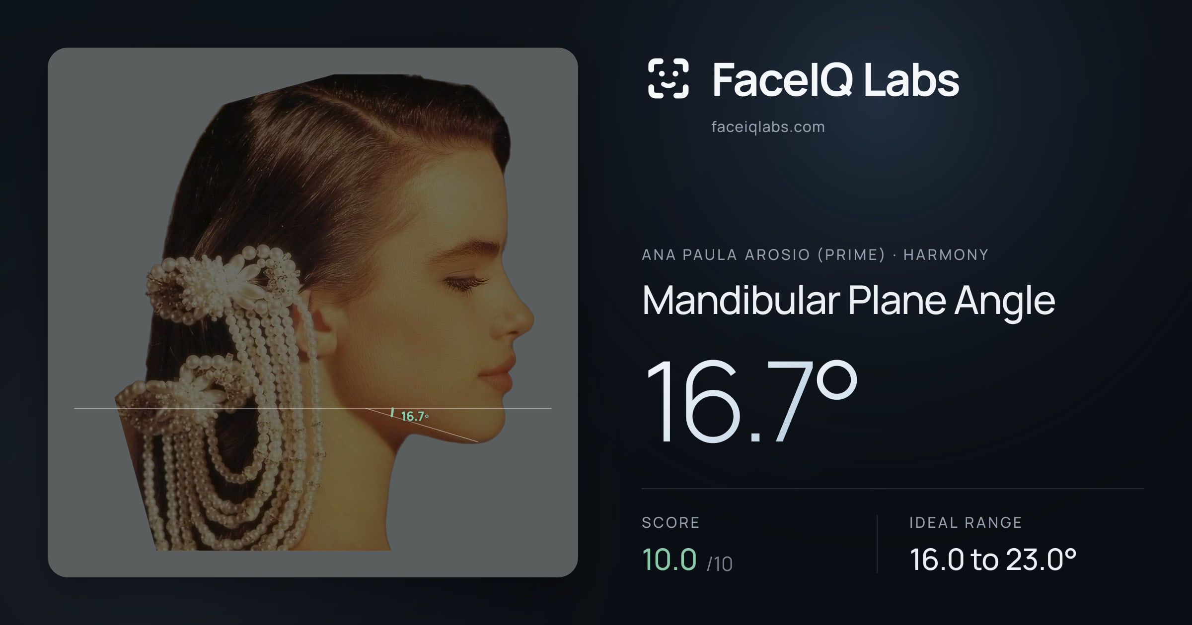 Ana paula arosio (prime) Mandibular Plane Angle: 16.7°, drawn on the photo