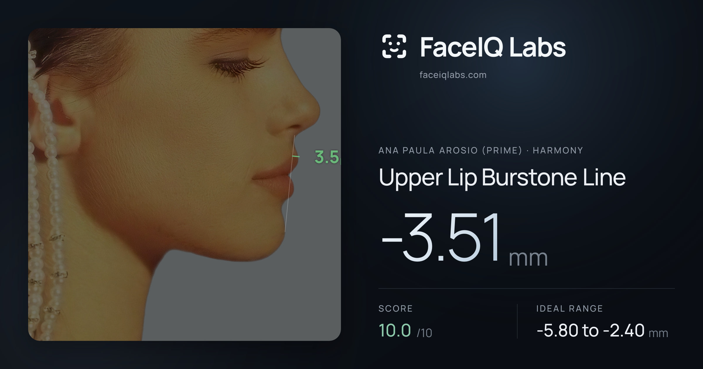 Ana paula arosio (prime) Upper Lip Burstone Line: -3.51mm, drawn on the photo
