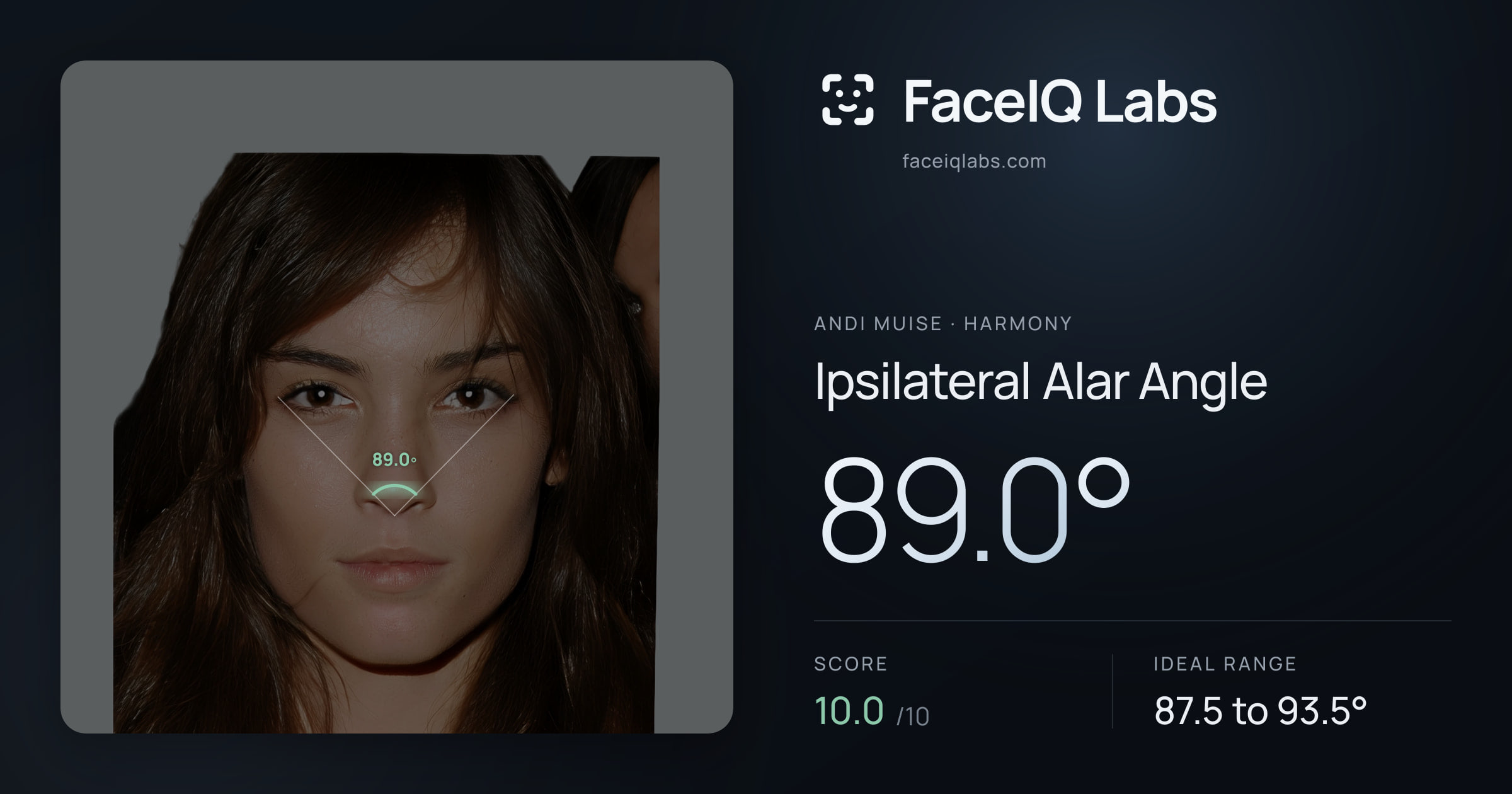 Andi Muise Ipsilateral Alar Angle: 89.0°, drawn on the photo