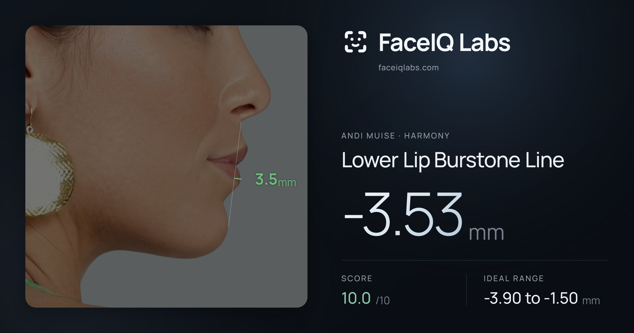 Andi Muise Lower Lip Burstone Line: -3.53mm, drawn on the photo