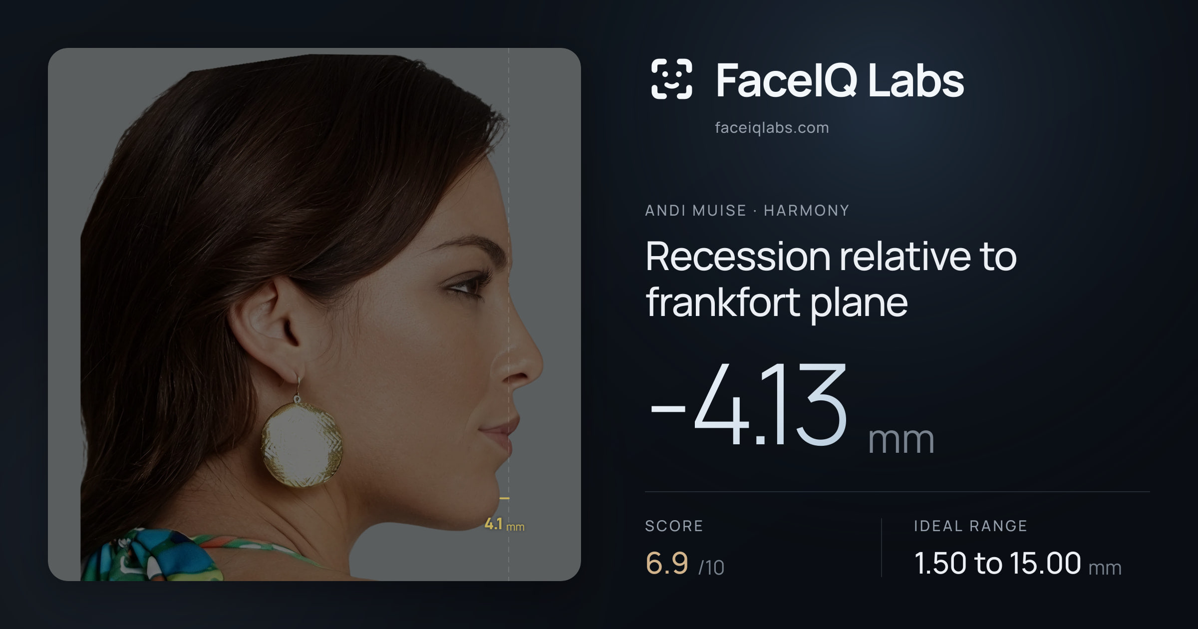 Andi Muise Recession relative to frankfort plane: -4.13mm, drawn on the photo