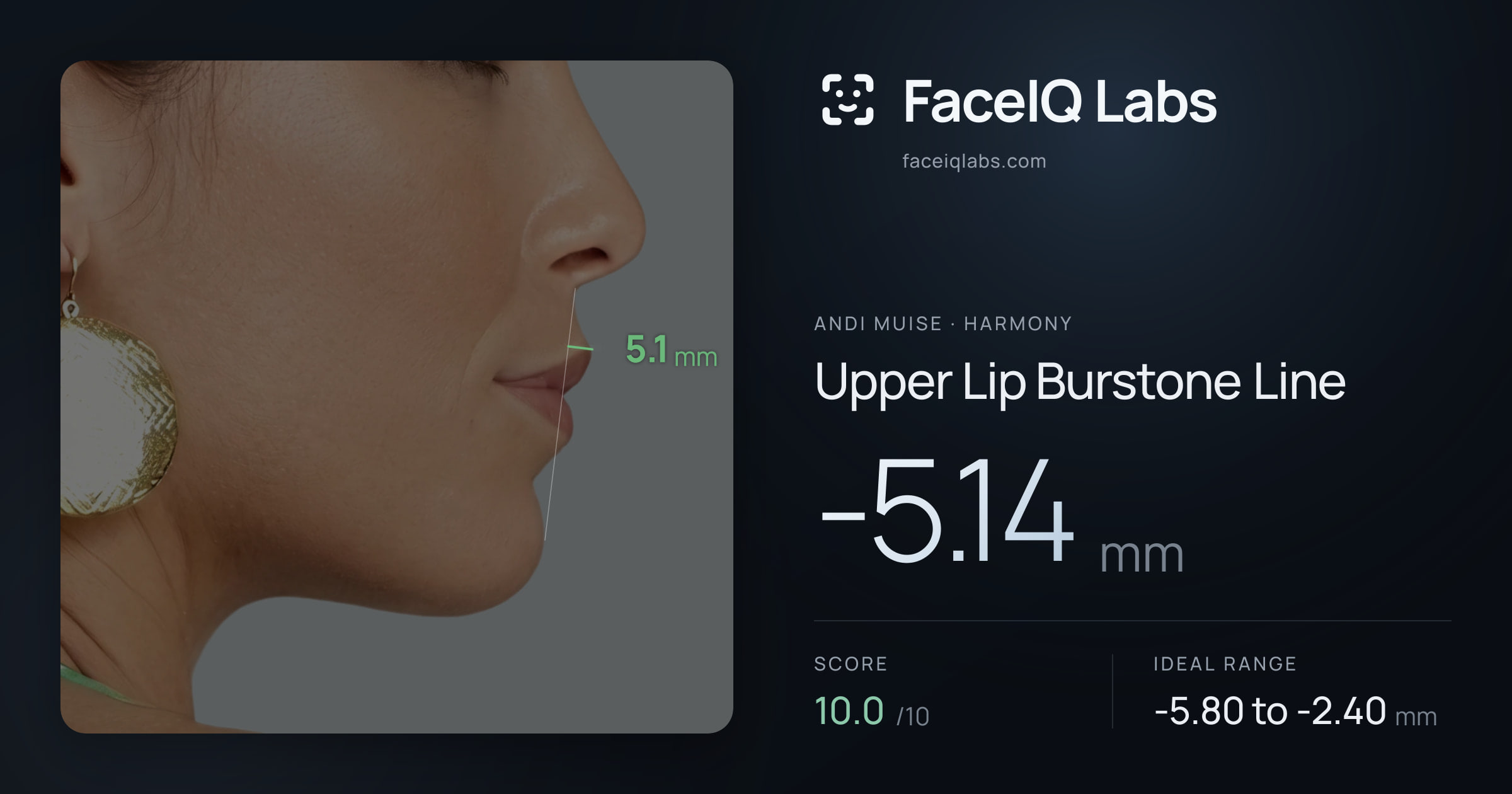 Andi Muise Upper Lip Burstone Line: -5.14mm, drawn on the photo