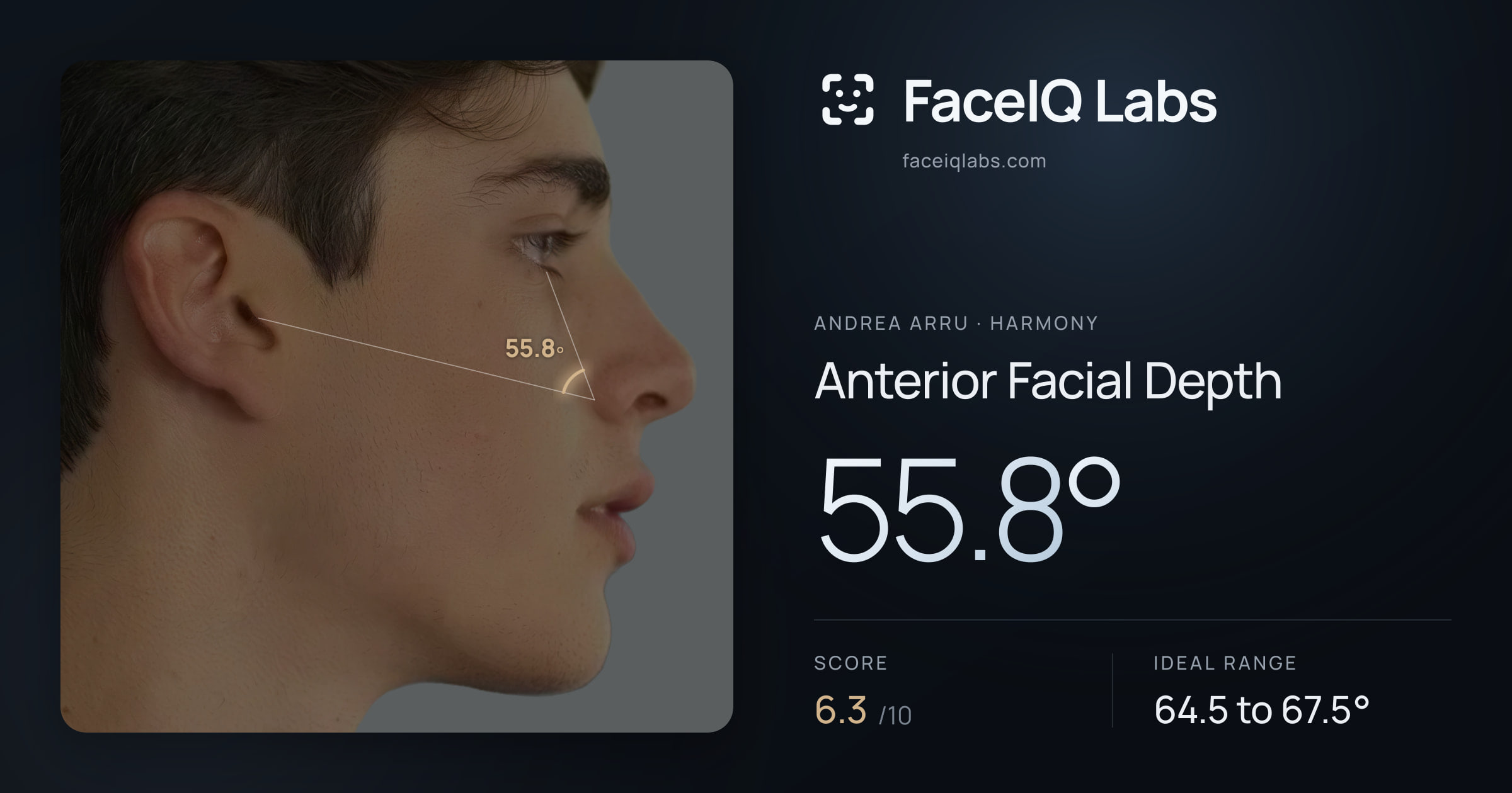 Andrea Arru Anterior Facial Depth: 55.8°, drawn on the photo