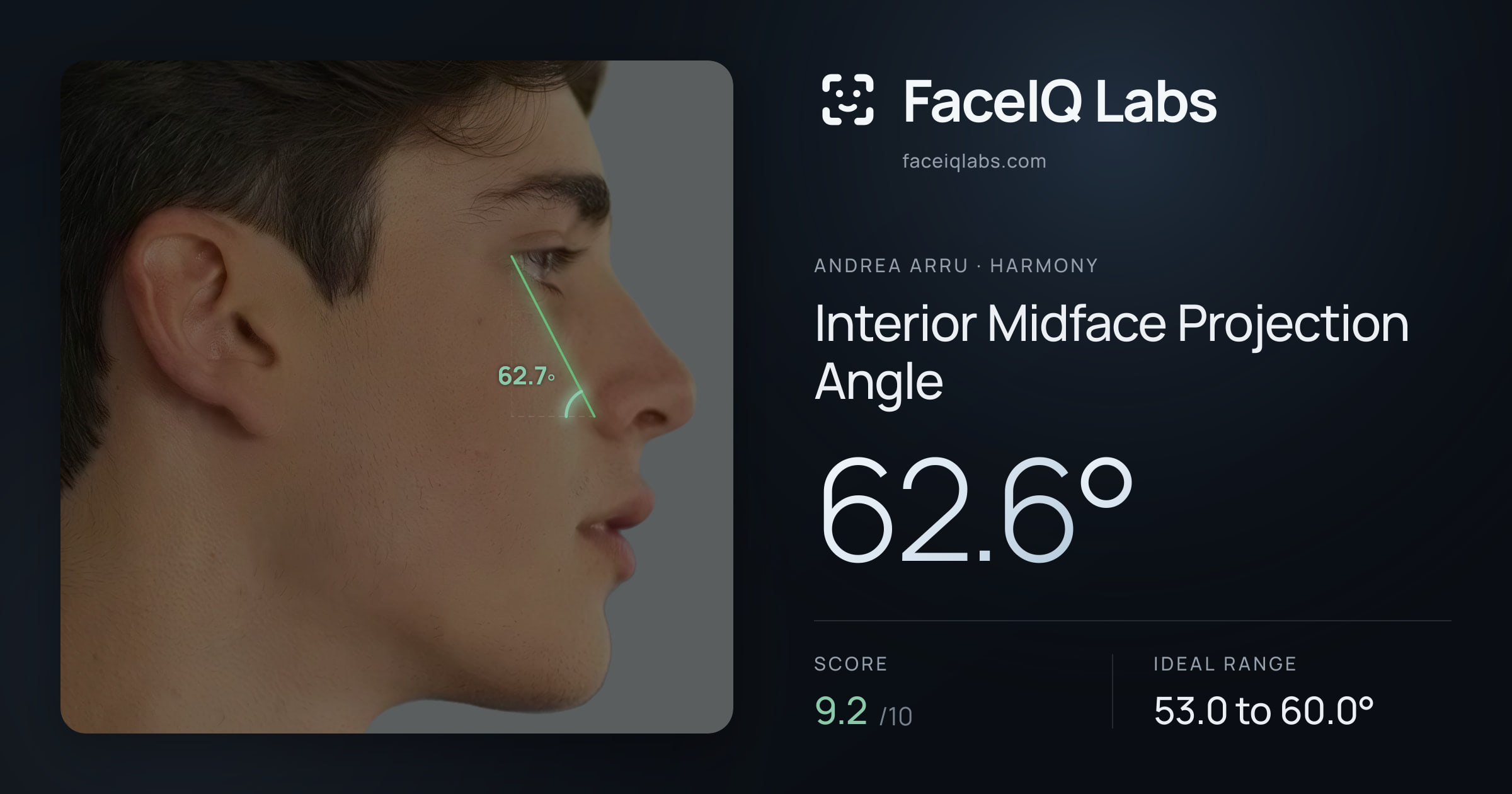 Andrea Arru Interior Midface Projection Angle: 62.6°, drawn on the photo