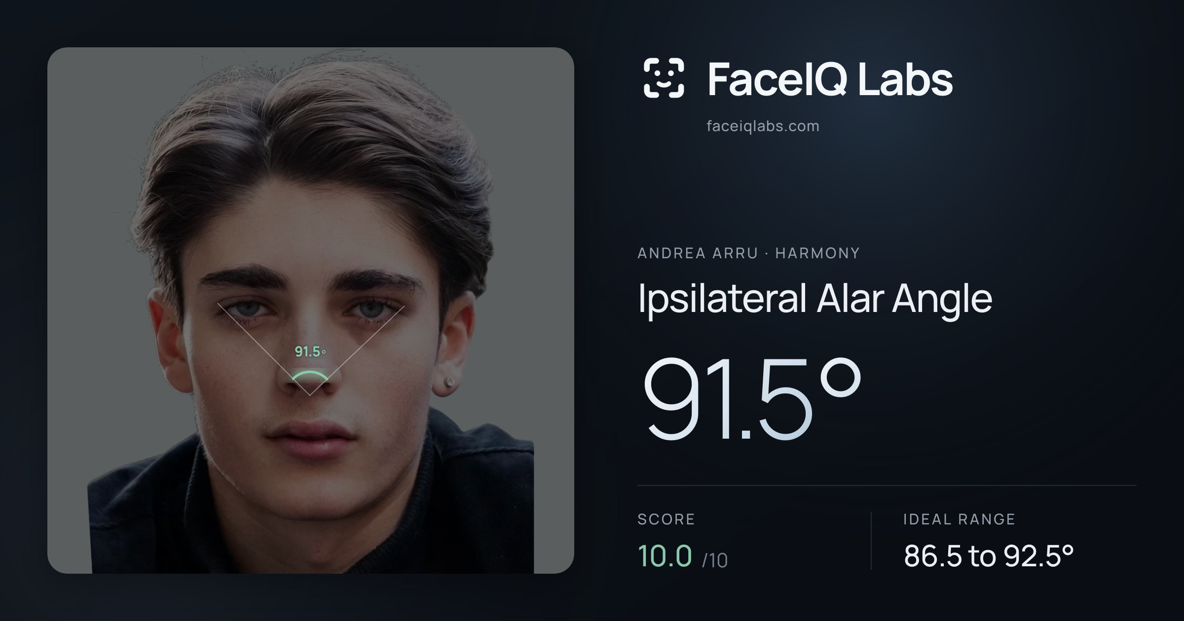 Andrea Arru Ipsilateral Alar Angle: 91.5°, drawn on the photo