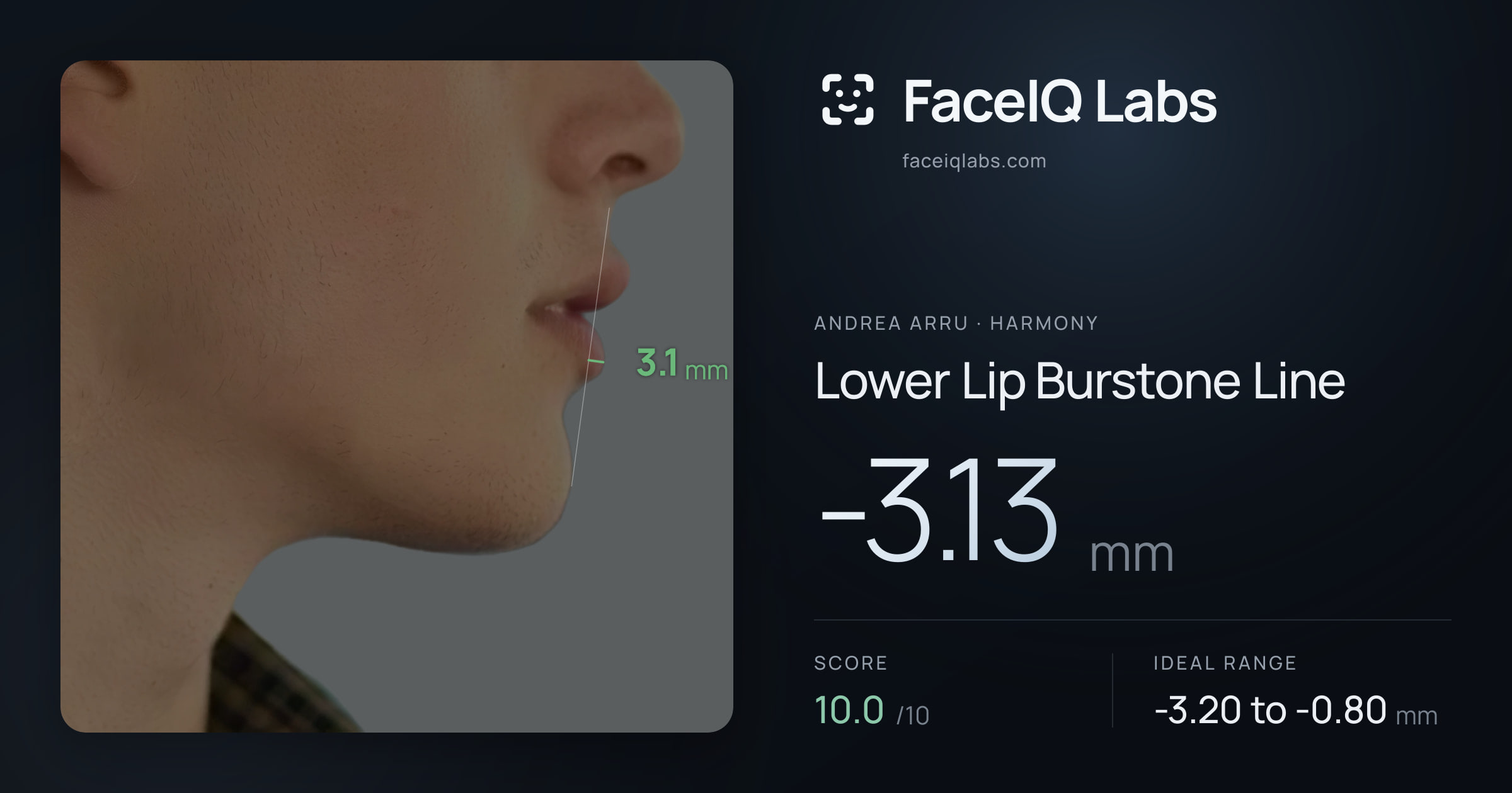Andrea Arru Lower Lip Burstone Line: -3.13mm, drawn on the photo