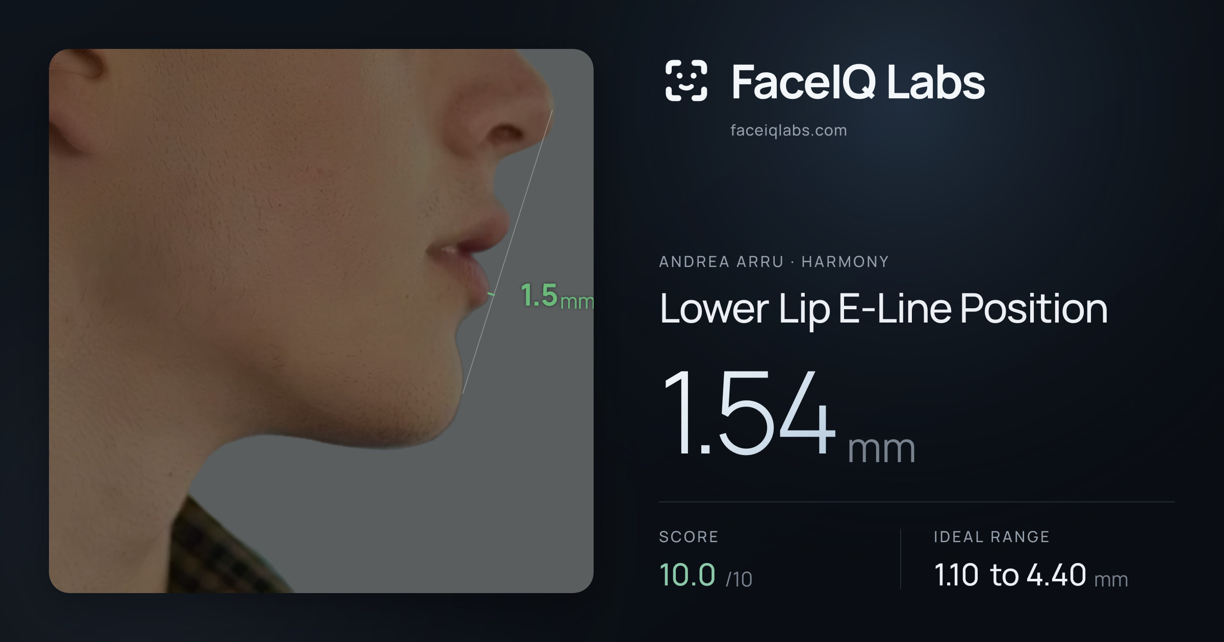 Andrea Arru Lower Lip E-Line Position: 1.54mm, drawn on the photo