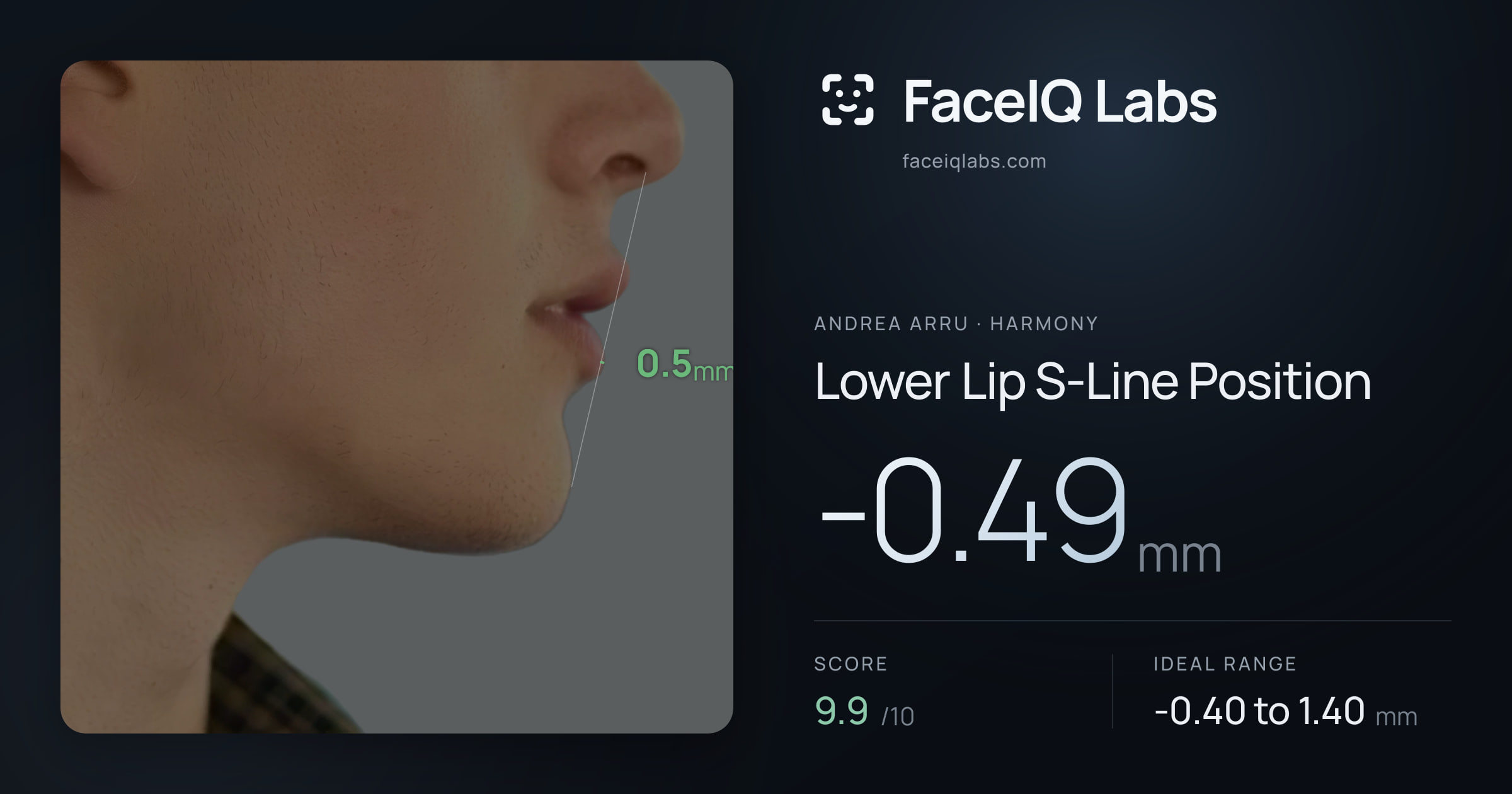 Andrea Arru Lower Lip S-Line Position: -0.49mm, drawn on the photo