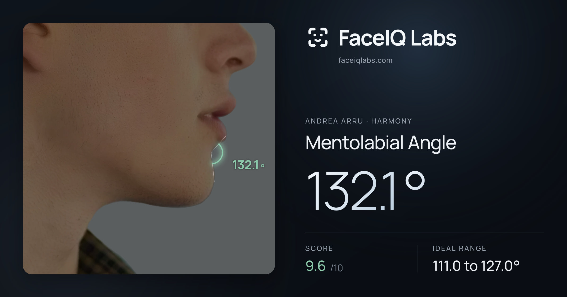 Andrea Arru Mentolabial Angle: 132.1°, drawn on the photo