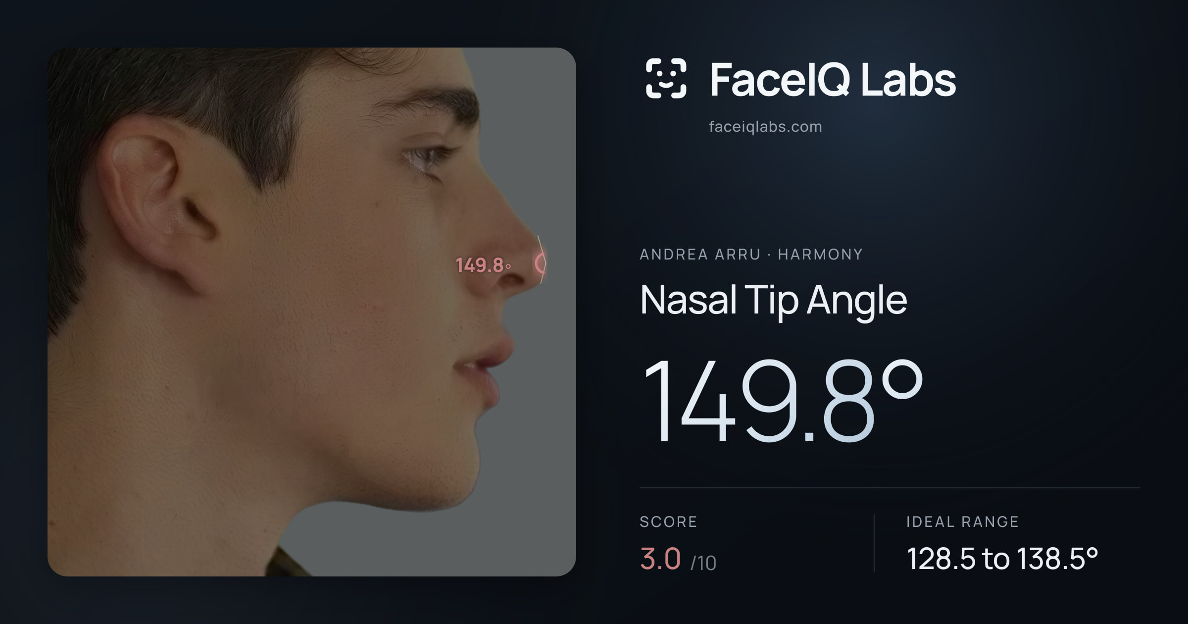 Andrea Arru Nasal Tip Angle: 149.8°, drawn on the photo
