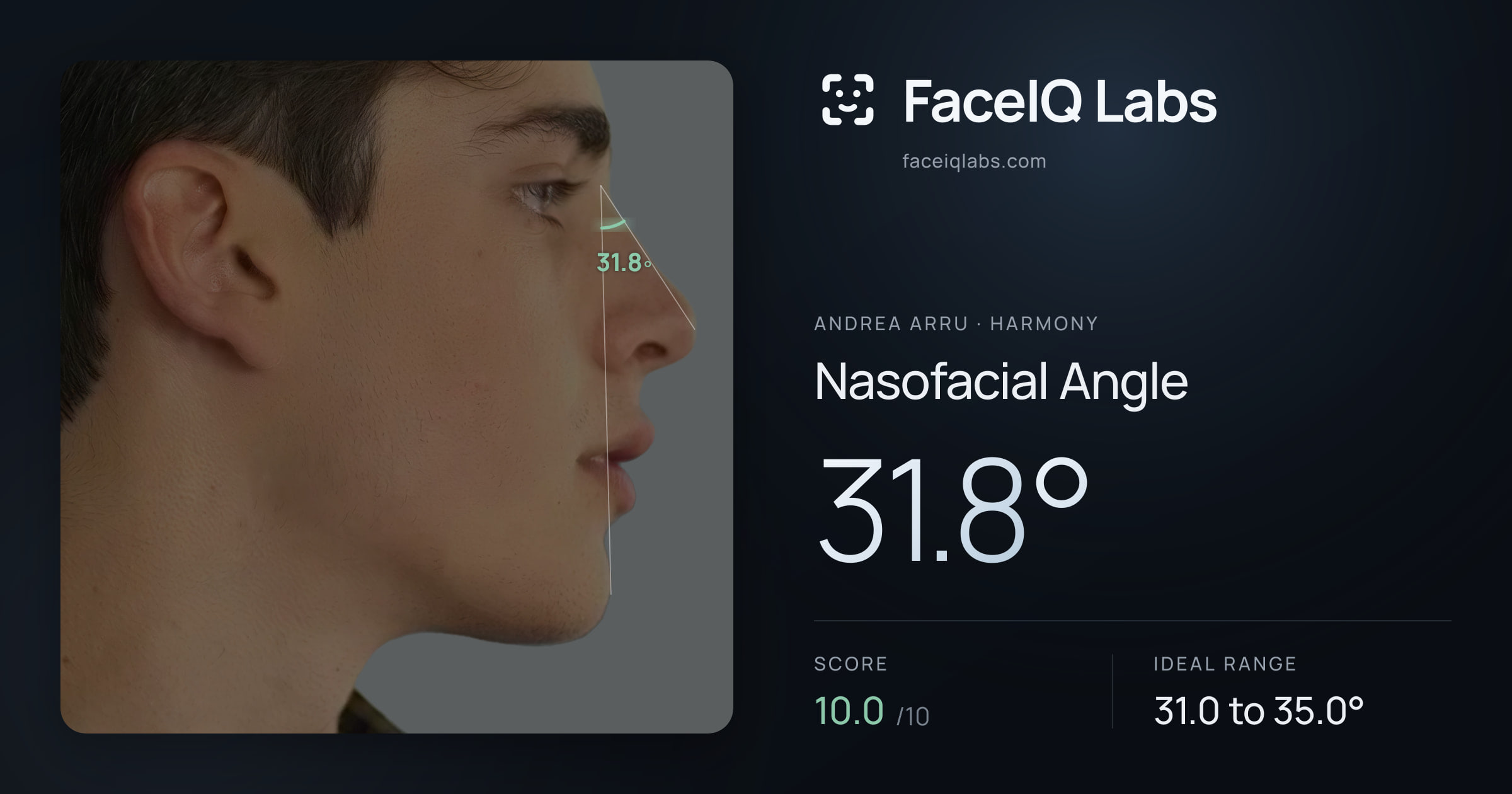 Andrea Arru Nasofacial Angle: 31.8°, drawn on the photo