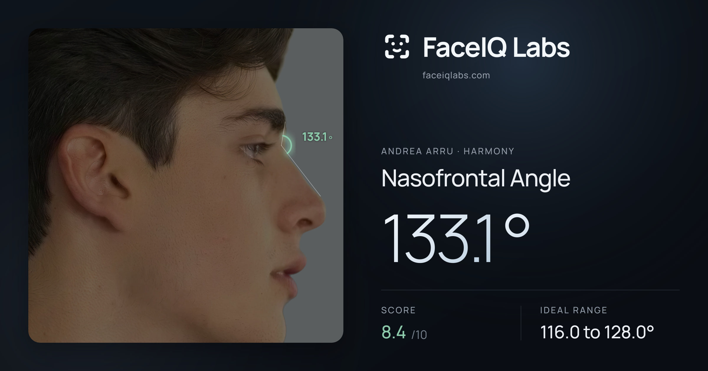 Andrea Arru Nasofrontal Angle: 133.1°, drawn on the photo