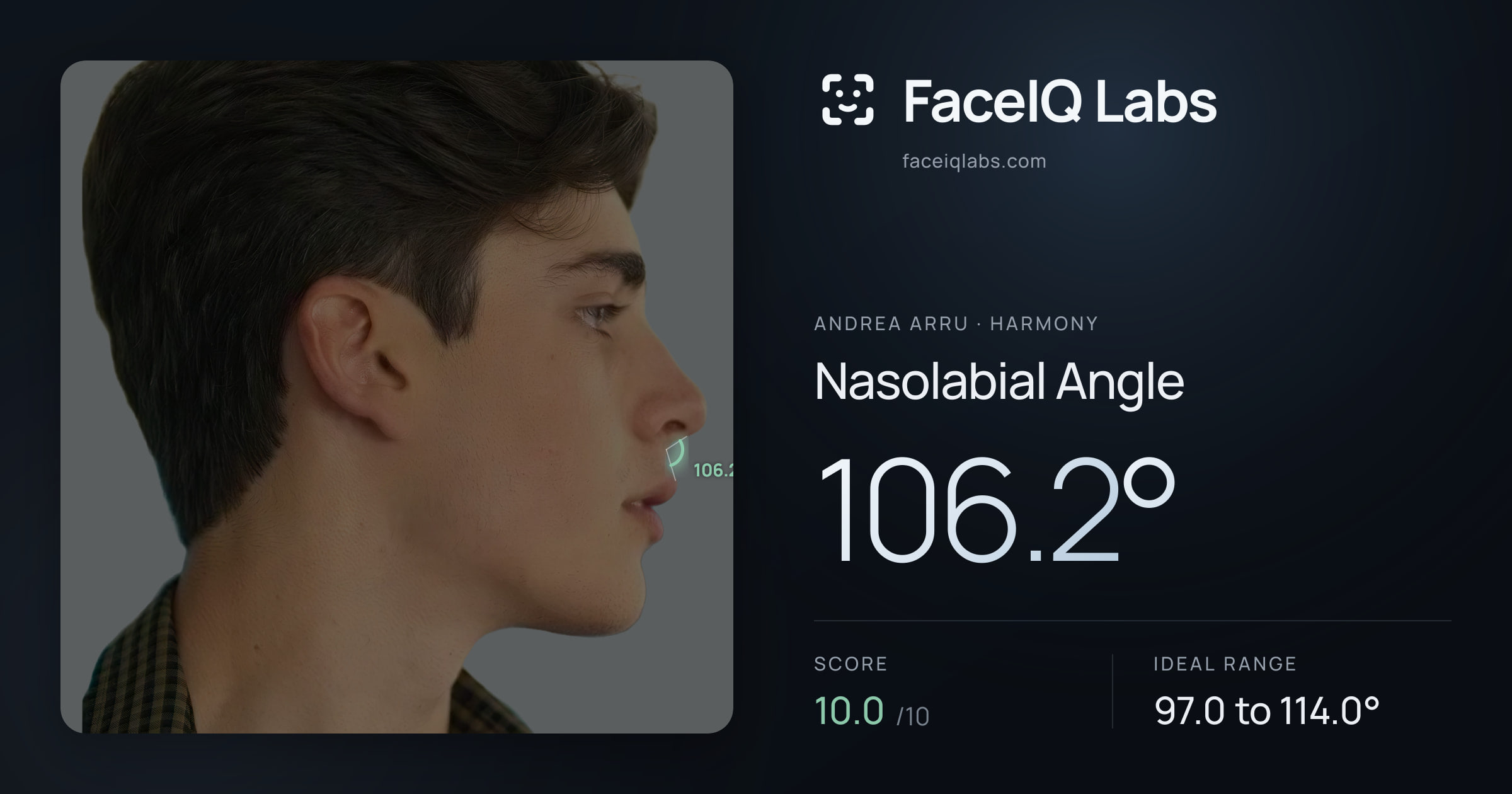 Andrea Arru Nasolabial Angle: 106.2°, drawn on the photo