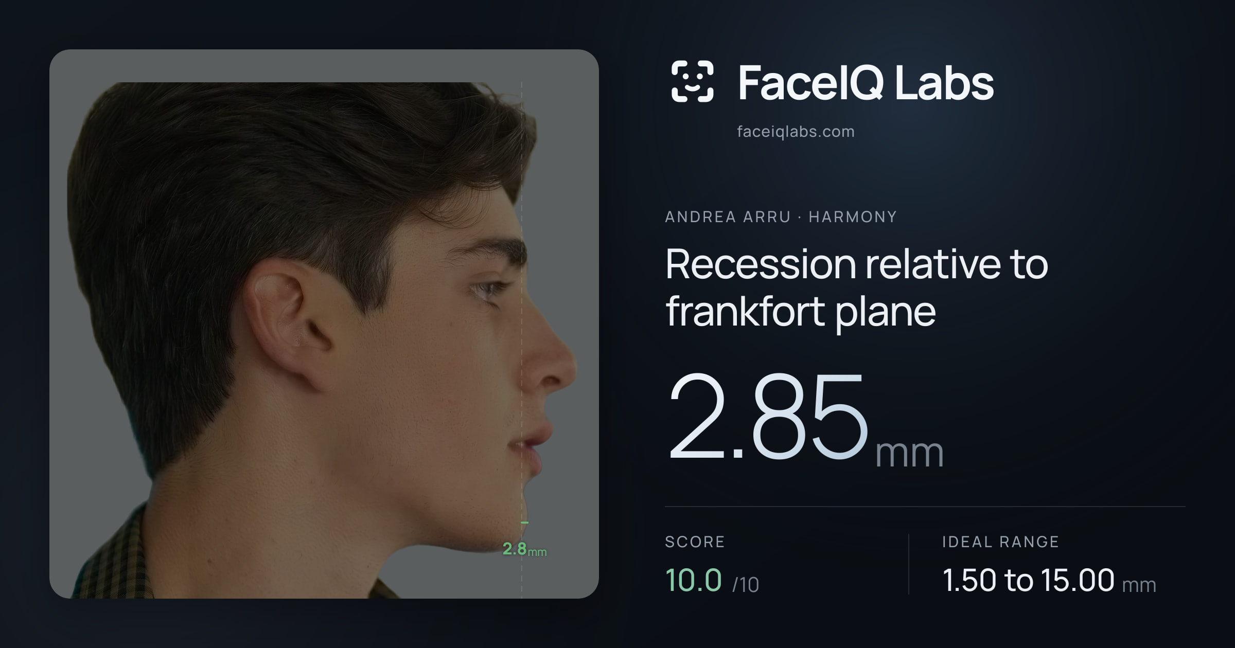 Andrea Arru Recession relative to frankfort plane: 2.85mm, drawn on the photo
