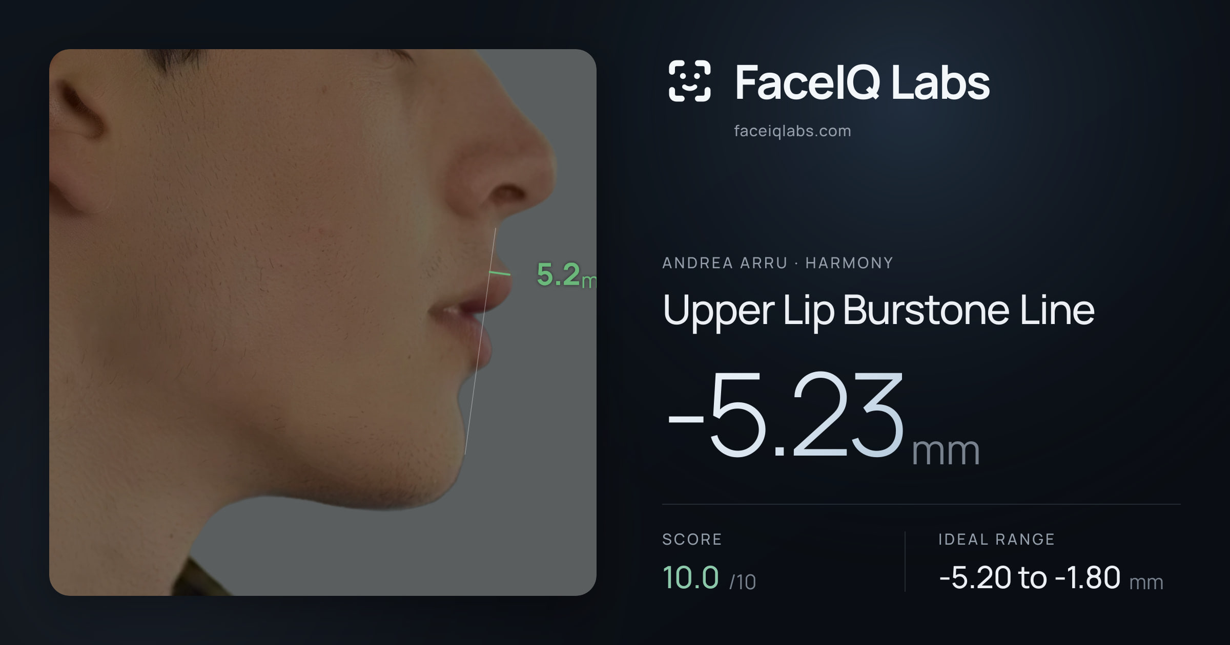 Andrea Arru Upper Lip Burstone Line: -5.23mm, drawn on the photo