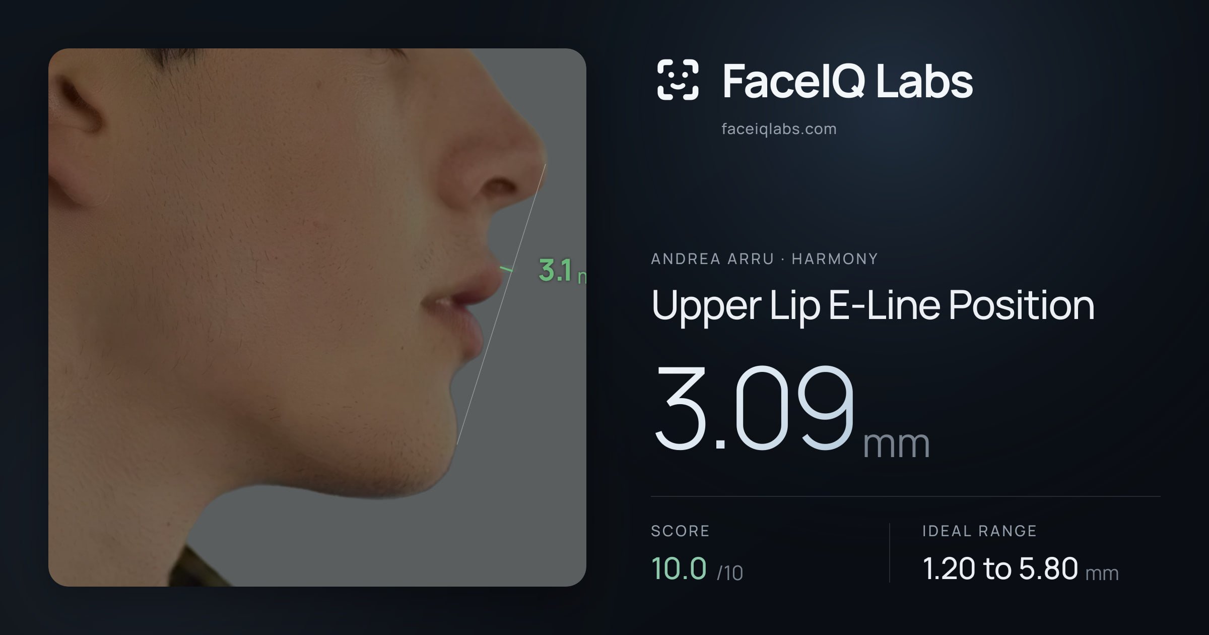Andrea Arru Upper Lip E-Line Position: 3.09mm, drawn on the photo