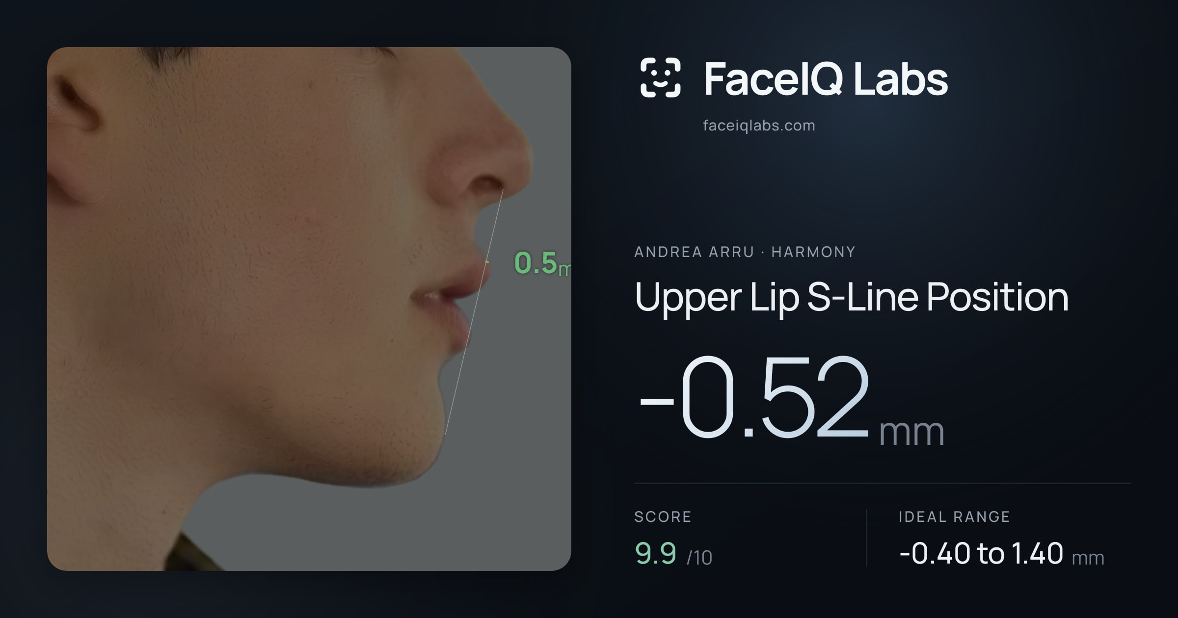 Andrea Arru Upper Lip S-Line Position: -0.52mm, drawn on the photo