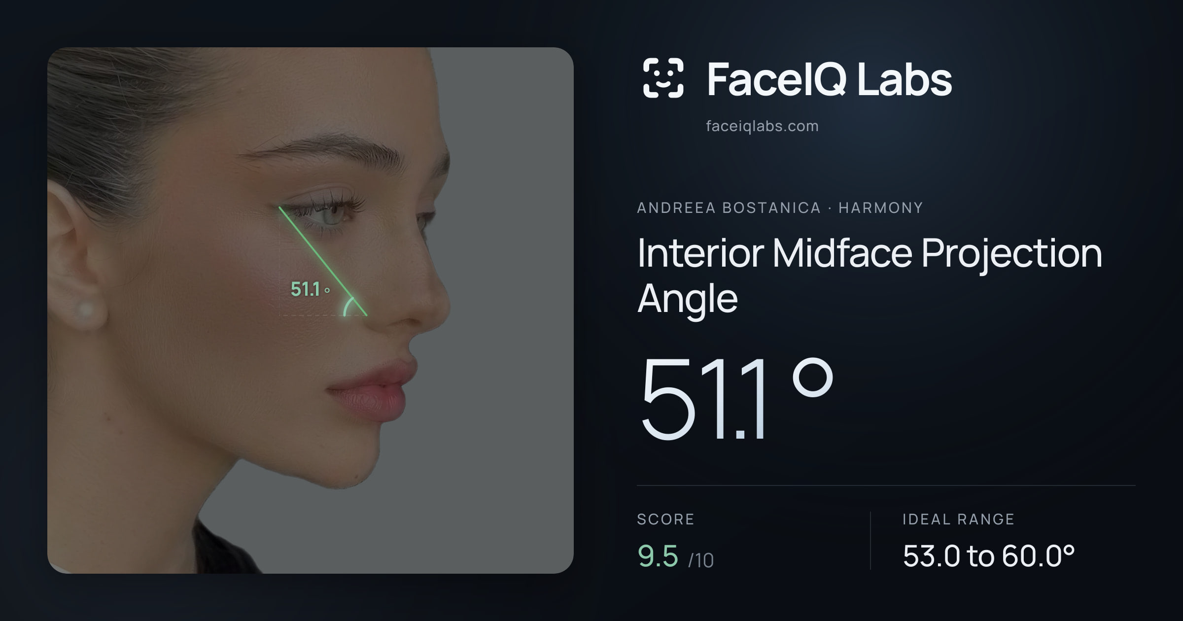Andreea Bostanica Interior Midface Projection Angle: 51.1°, drawn on the photo