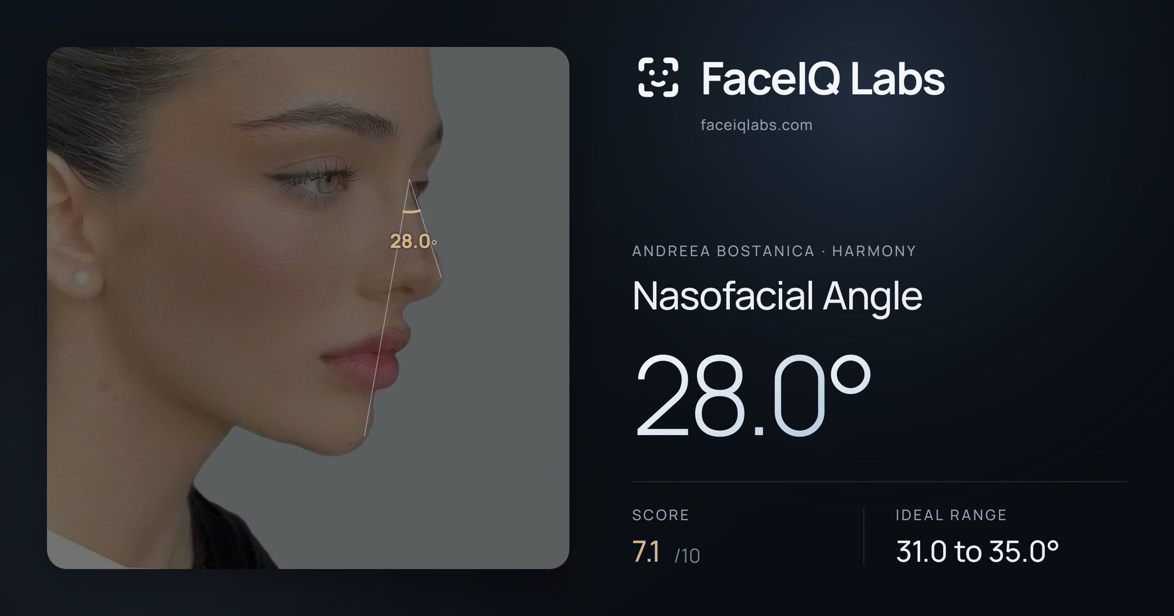 Andreea Bostanica Nasofacial Angle: 28.0°, drawn on the photo