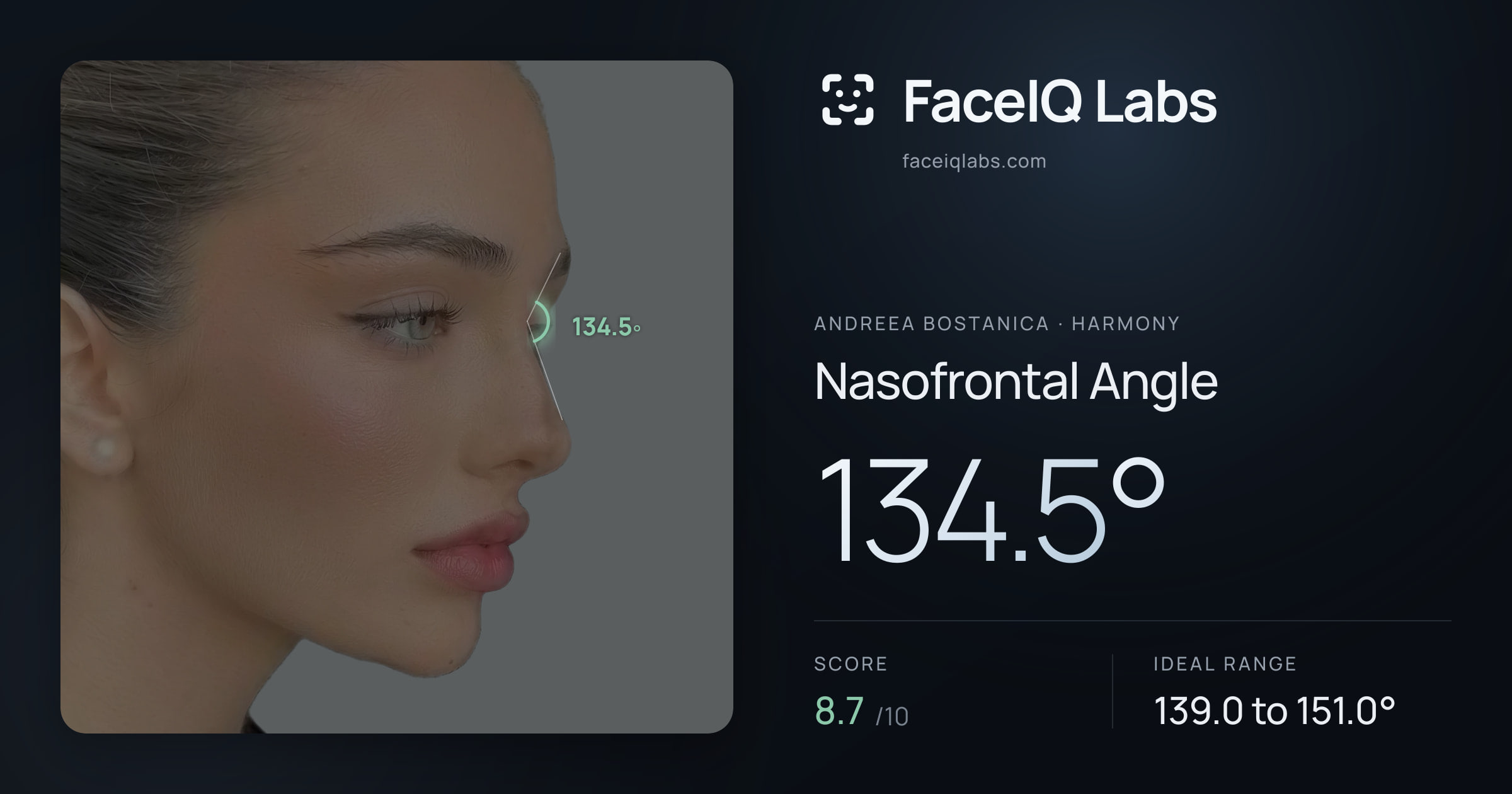 Andreea Bostanica Nasofrontal Angle: 134.5°, drawn on the photo