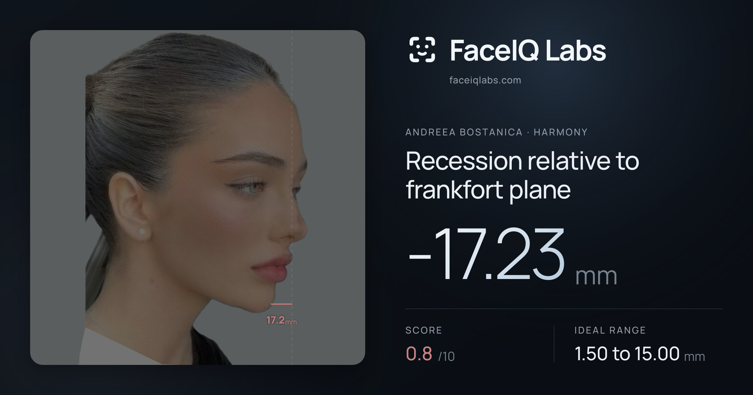 Andreea Bostanica Recession relative to frankfort plane: -17.23mm, drawn on the photo