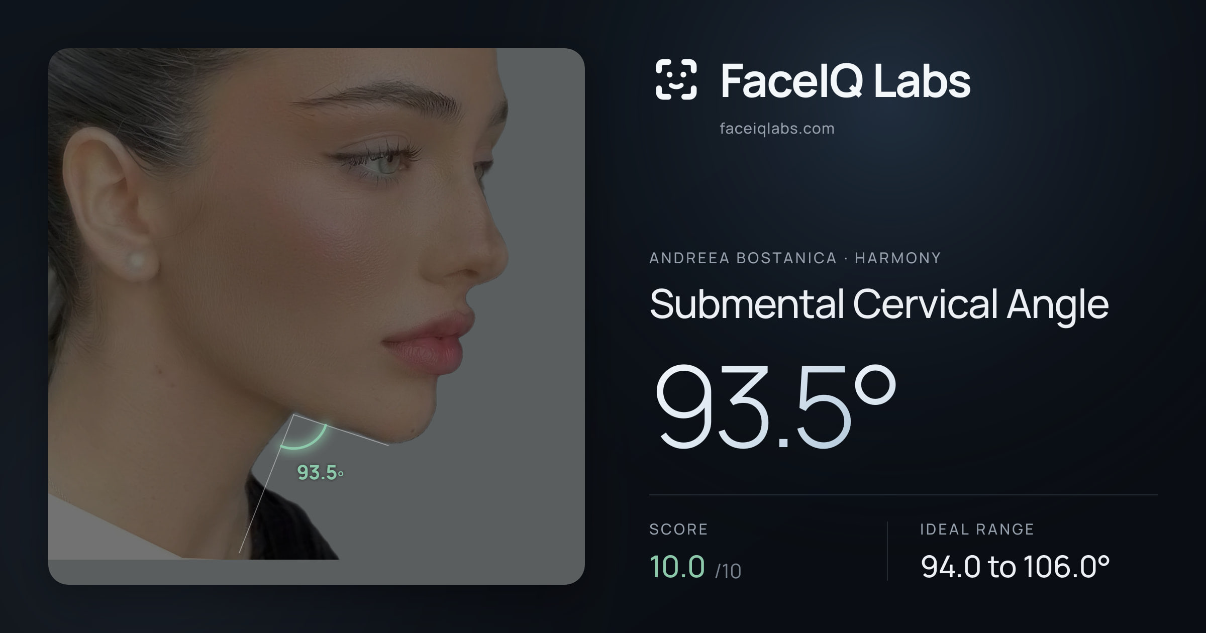 Andreea Bostanica Submental Cervical Angle: 93.5°, drawn on the photo