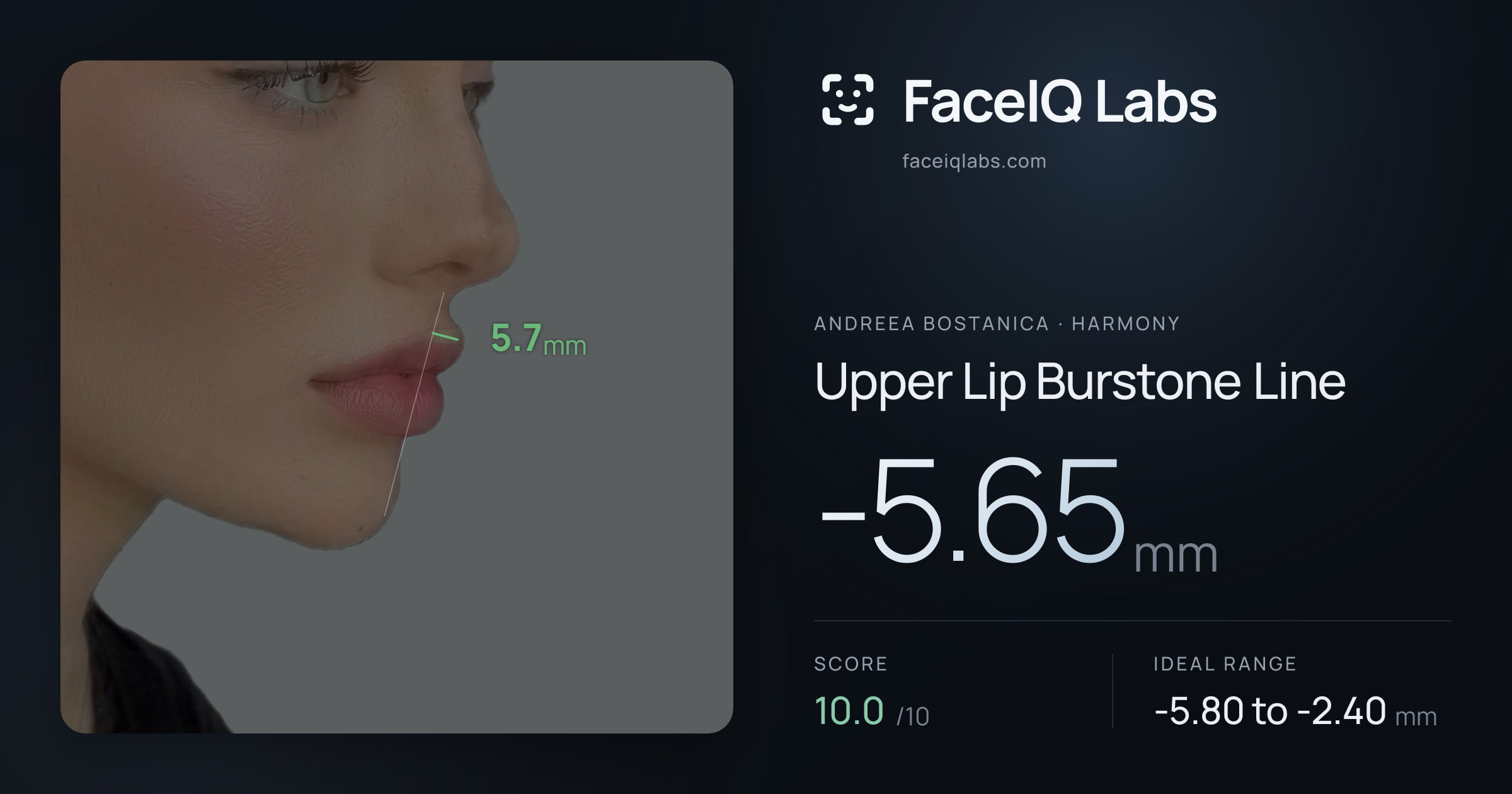 Andreea Bostanica Upper Lip Burstone Line: -5.65mm, drawn on the photo