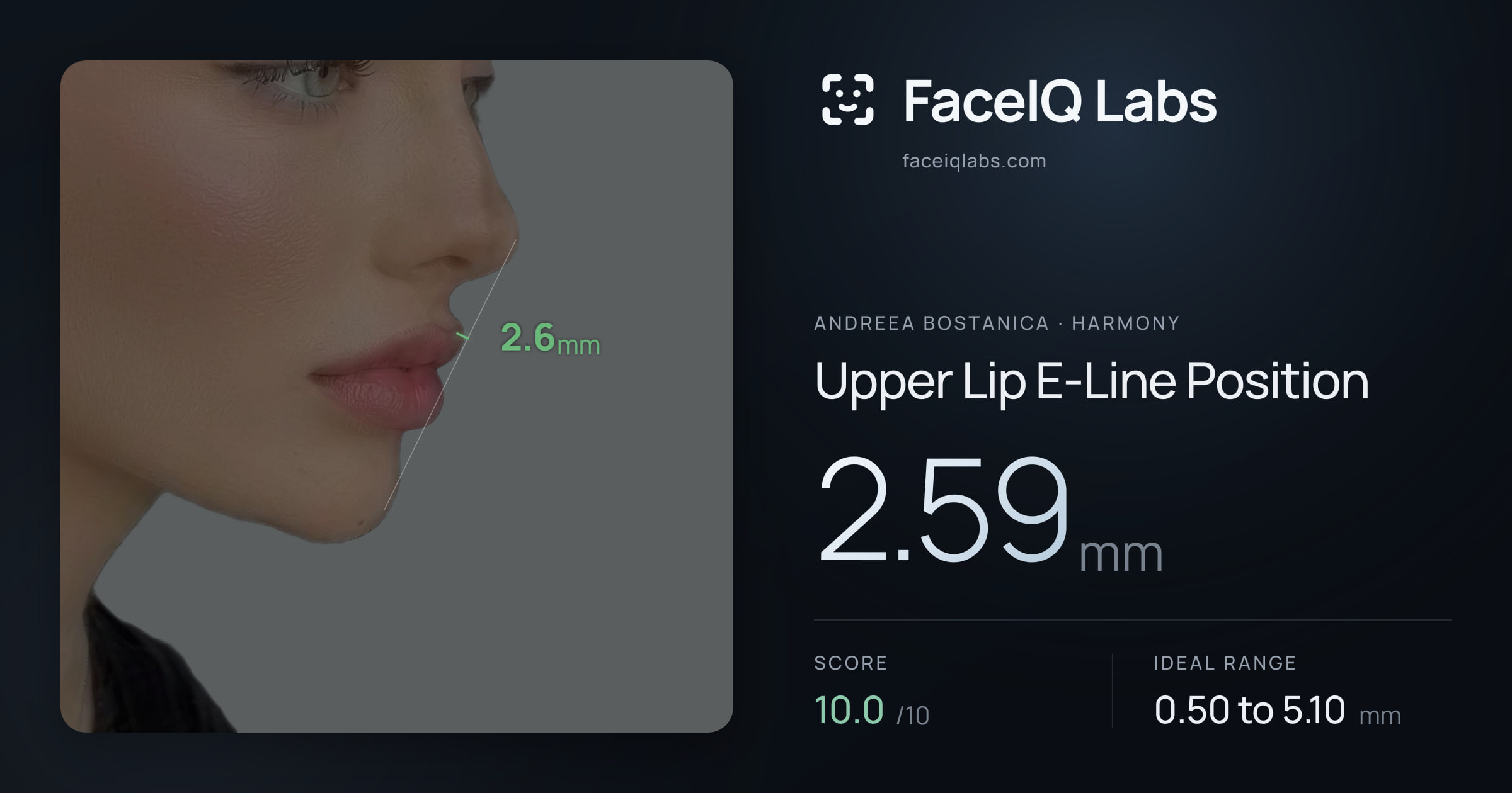 Andreea Bostanica Upper Lip E-Line Position: 2.59mm, drawn on the photo